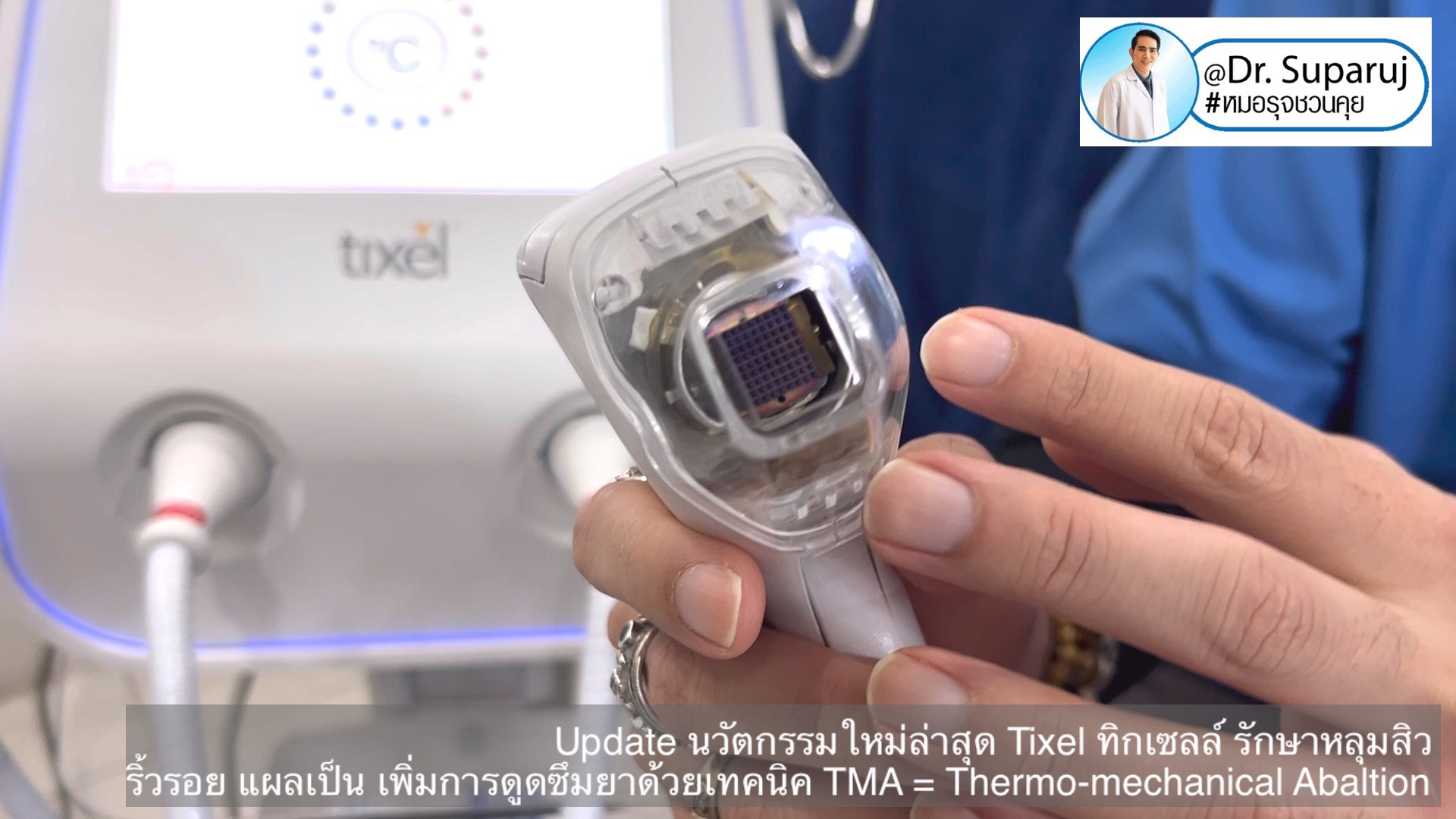 Update นวัตกรรมใหม่ล่าสุด Tixel ทิ๊กเซลล์ รักษาหลุมสิว ริ้วรอย แผลเป็น + Periorbital Tixel Treatment ดูแลริ้วรอยเปลือกตาและรอบดวงตาด้วยเทคนิค TMA = Thermo-mechanical Abaltion