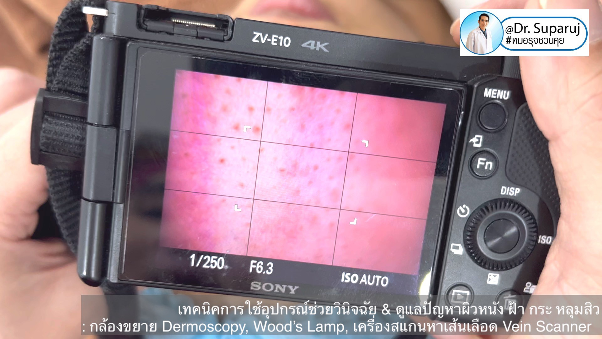 เทคนิคการใช้อุปกรณ์ช่วยวินิจฉัย & ดูแลปัญหาผิวหนัง ฝ้า กระ หลุมสิว: กล้องขยาย Dermoscopy, แว่นขยายพร้อมแสงในช่วงUV: Wood’s Lamp, เครื่องสแกนหาเส้นเลือด Vein Scanner เทคนิคการใช้อุปกรณ์ช่วยวินิจฉัย & ดูแลปัญหาผิวหนัง ฝ้า กระ หลุมสิว: กล้องขยาย Dermoscopy, แว่นขยายพร้อมแสงในช่วงUV: Wood’s Lamp, เครื่องสแกนหาเส้นเลือด Vein Scanner