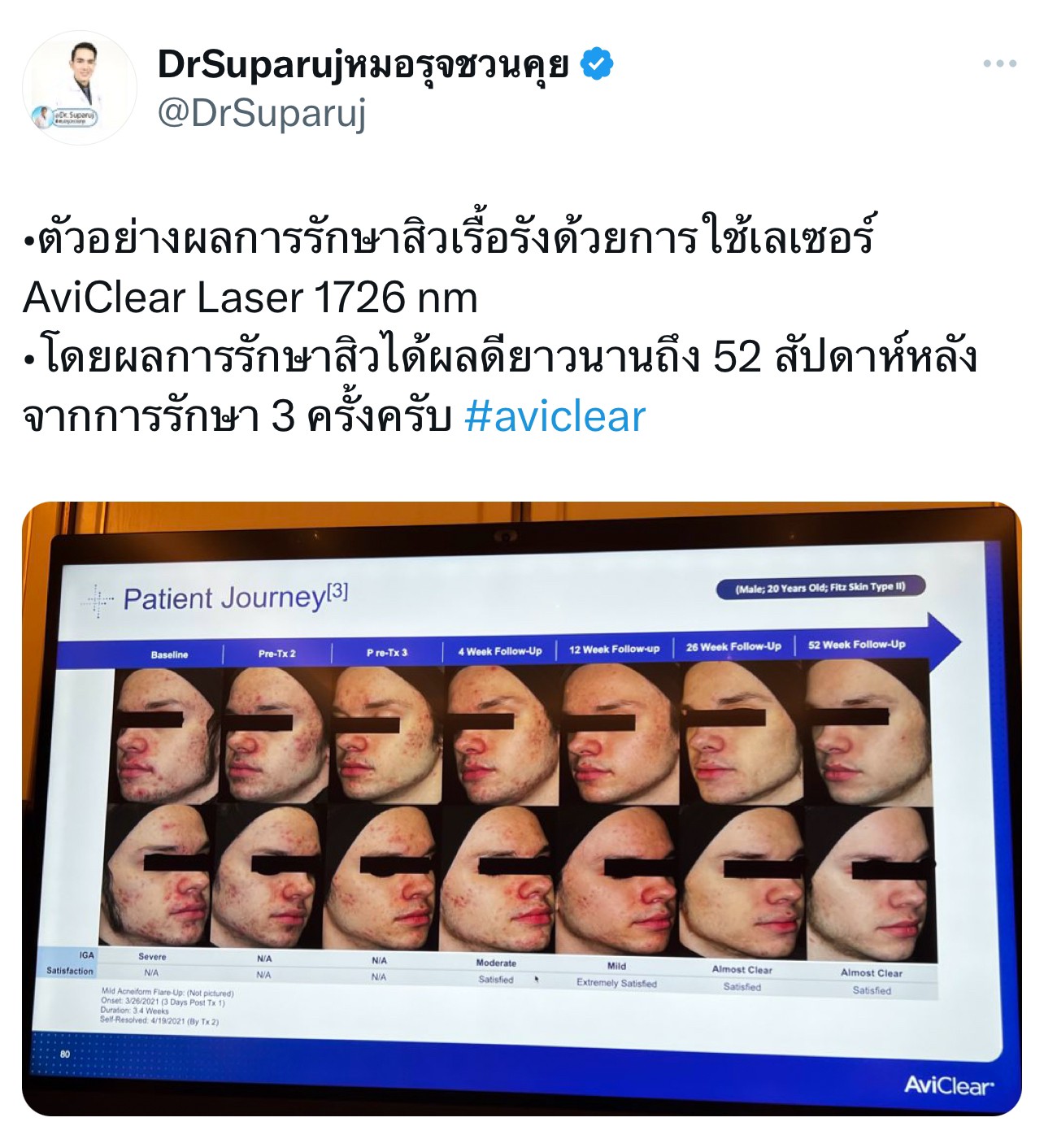 Update เครื่องเลเซอร์สำหรับรักษาสิวโดยเฉพาะ จับกับต่อมไขมันโดยตรง = AviClear 1726 nm Laser Update เครื่องเลเซอร์สำหรับรักษาสิวโดยเฉพาะ จับกับต่อมไขมันโดยตรง = AviClear 1726 nm Laser