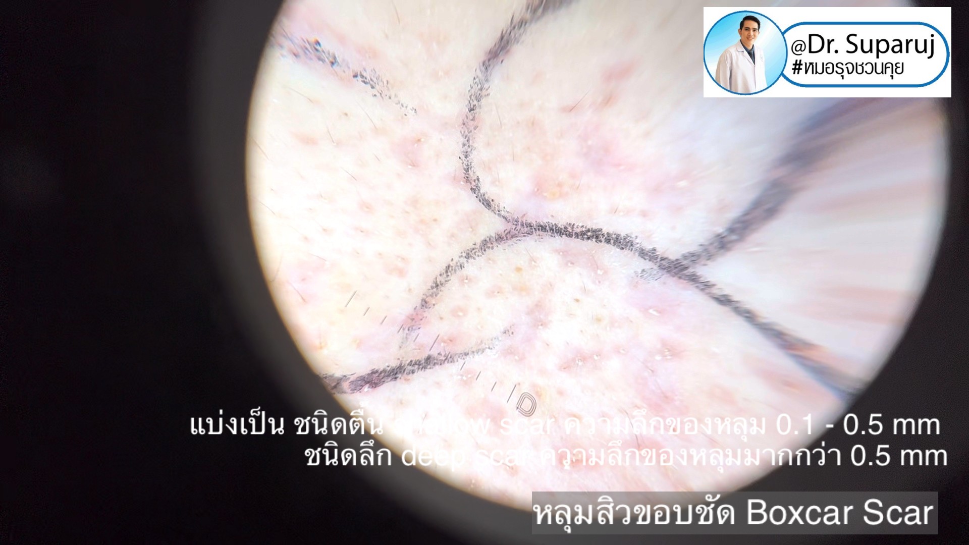 Back to the Basics: หลุมสิวมีกี่ชนิด & มีลักษณะอย่างไร ? Acne Scar Classification Full Clip คลิปเต็ม Facebook/ YouTube Dr. Suparuj หมอรุจชวนคุย ครับ Back to the Basics: หลุมสิวมีกี่ชนิด & มีลักษณะอย่างไร ? Acne Scar Classification Full Clip คลิปเต็ม Facebook/ YouTube Dr. Suparuj หมอรุจชวนคุย ครับ