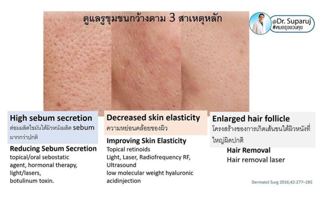 รูขุมขนกว้าง Enlarged Facial Pore เกิดจากอะไร ? + เทคนิคดูแลด้วยโปรแกรม Discovery Pico Laser หลายความยาวคลื่น +หลายพลังงานร่วมกัน รูขุมขนกว้าง Enlarged Facial Pore เกิดจากอะไร ? + เทคนิคดูแลด้วยโปรแกรม Discovery Pico Laser หลายความยาวคลื่น +หลายพลังงานร่วมกัน