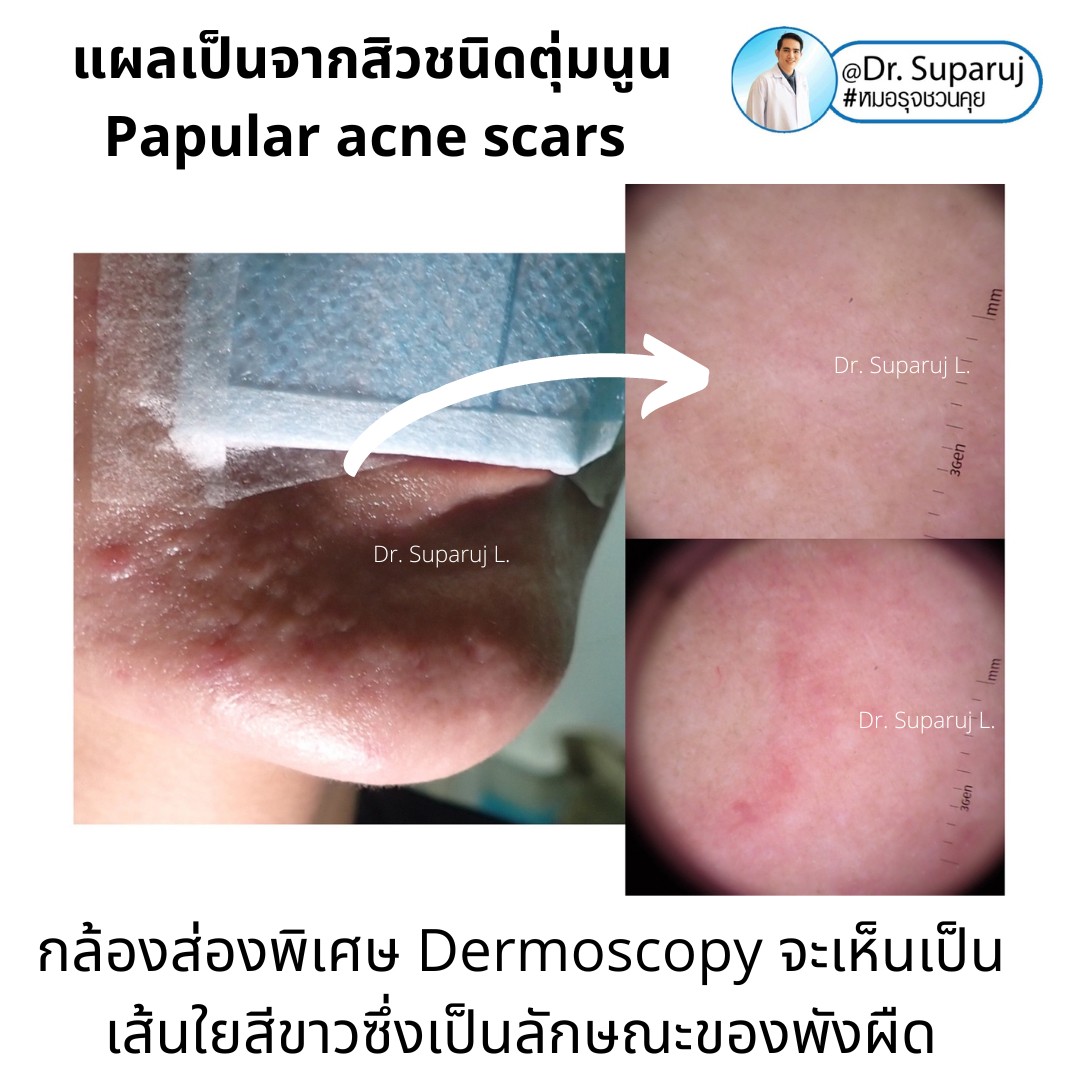 เทคนิคดูแลแผลเป็นตุ่มนูนจากสิว Papular acne scar ที่จมูก + คาง ด้วย Fractional Discovery Picosecond Laser + Deep Focused Ablative Laser เทคนิคดูแลแผลเป็นตุ่มนูนจากสิว Papular acne scar ที่จมูก + คาง ด้วย Fractional Discovery Picosecond Laser + Deep Focused Ablative Laser