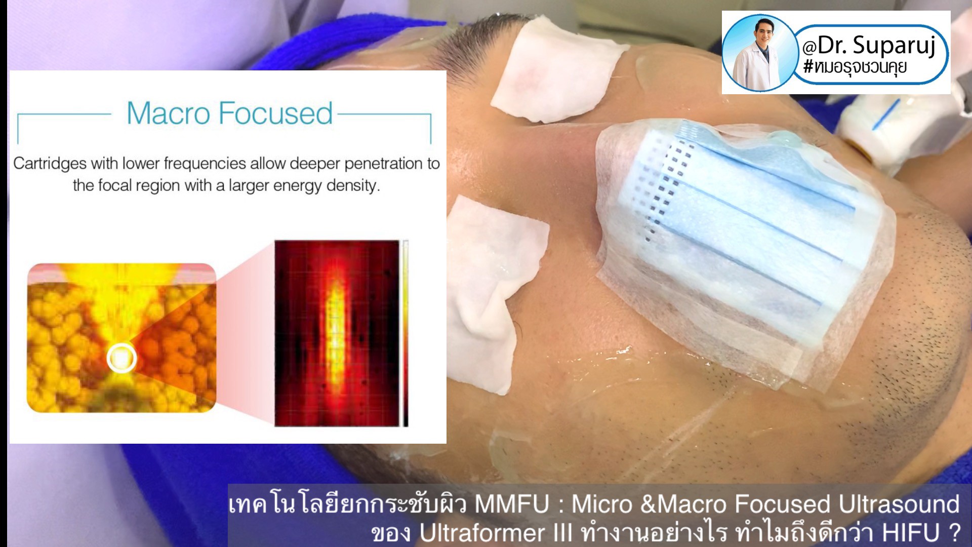 เทคโนโลยียกกระชับผิว MMFU : Micro &Macro Focused Ultrasound ของ Ultraformer III ทำงานอย่างไร ทำไมถึงดีกว่า HIFU ? เทคโนโลยียกกระชับผิว MMFU : Micro &Macro Focused Ultrasound ของ Ultraformer III ทำงานอย่างไร ทำไมถึงดีกว่า HIFU ?
