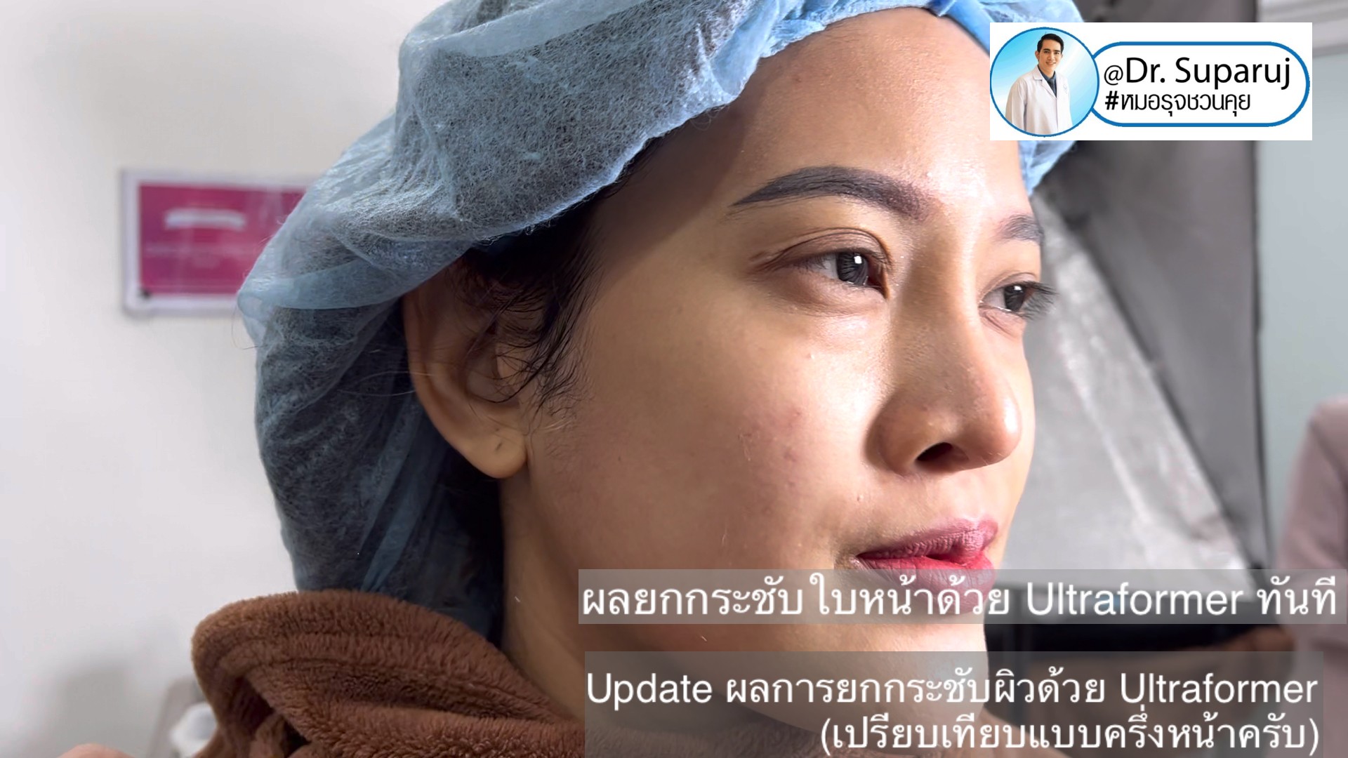 Update ผลการยกกระชับผิวด้วย Ultraformer III (เปรียบเทียบแบบครึ่งหน้าให้เห็นชัดๆครับ) Update ผลการยกกระชับผิวด้วย Ultraformer III (เปรียบเทียบแบบครึ่งหน้าให้เห็นชัดๆครับ)