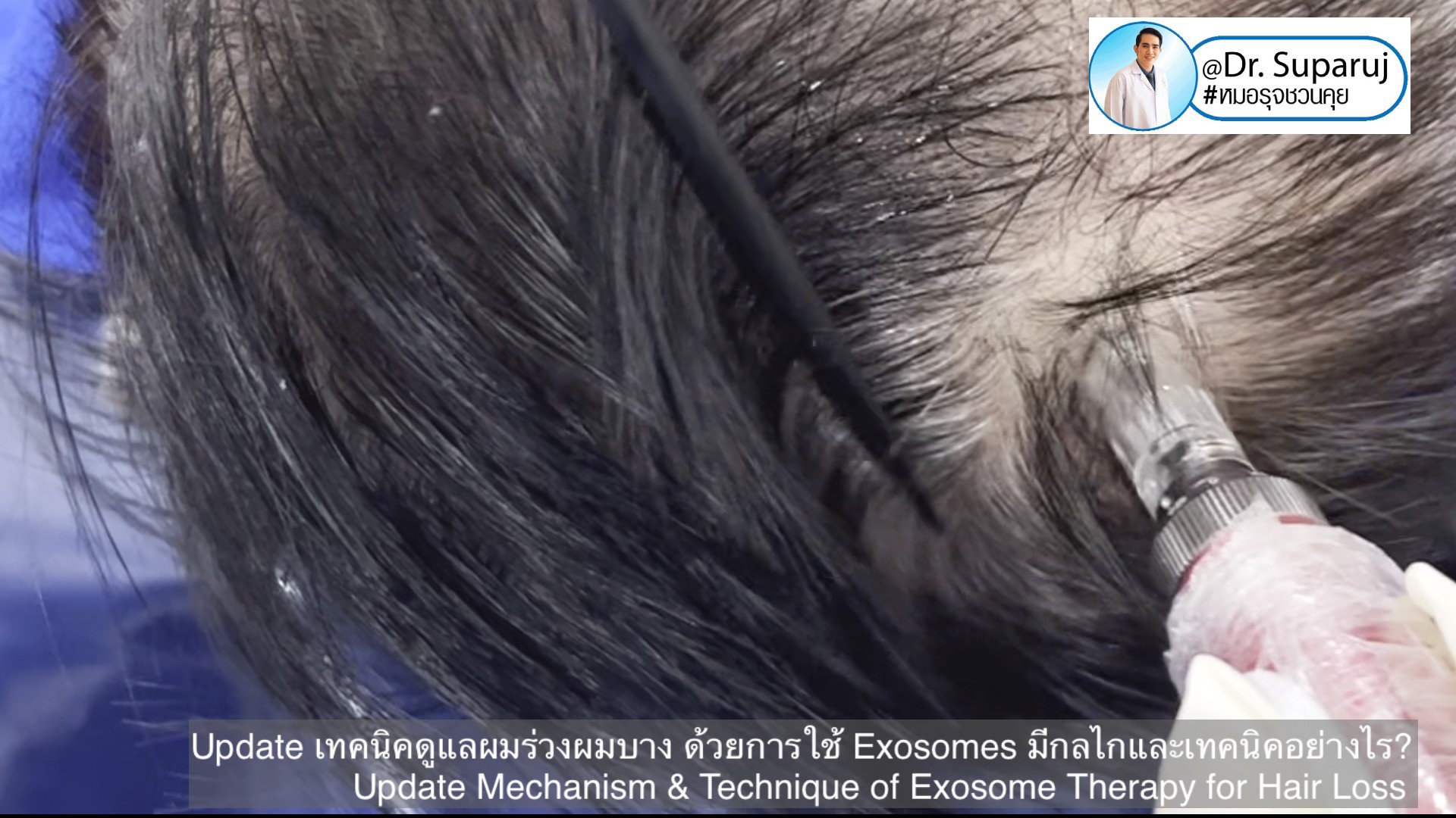 Update เทคนิค (เสริม)ดูแลผมร่วงผมบางจากพันธุกรรม AGA Update เทคนิค (เสริม)ดูแลผมร่วงผมบางจากพันธุกรรม AGA