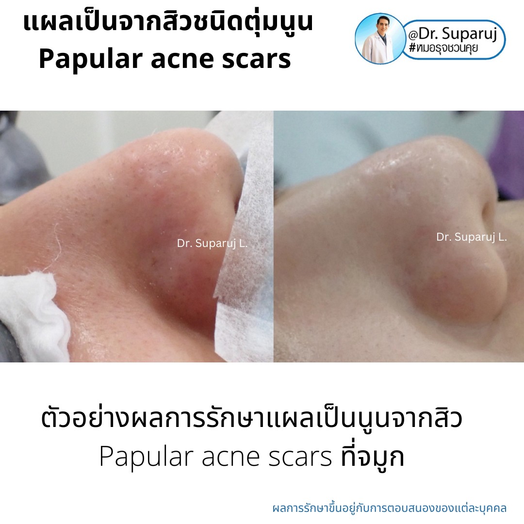 เทคนิคดูแลแผลเป็นตุ่มนูนจากสิว Papular acne scar ที่จมูก + คาง ด้วย Fractional Discovery Picosecond Laser + Deep Focused Ablative Laser เทคนิคดูแลแผลเป็นตุ่มนูนจากสิว Papular acne scar ที่จมูก + คาง ด้วย Fractional Discovery Picosecond Laser + Deep Focused Ablative Laser