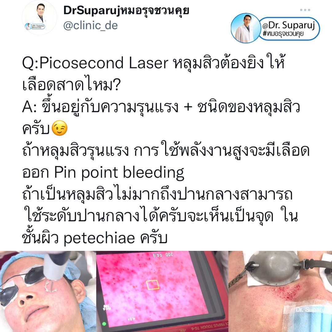 Q:Picosecond Laser หลุมสิวต้องยิงให้เลือดสาดไหม? Q:Picosecond Laser หลุมสิวต้องยิงให้เลือดสาดไหม?