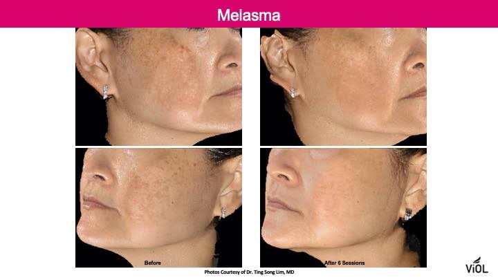 แนะนำเทคนิคดูแลฝ้า ด้วย SYLFIRM X Plus (SYLFIRMX Plus Fractional Radiofrequency Microneedle to Treat Melasma)