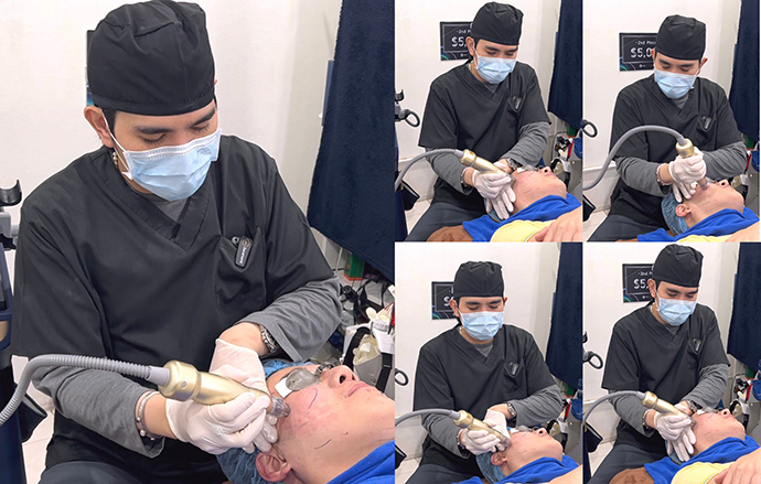 แนะนำเทคนิครักษาหลุมสิวด้วยโปรแกรม SYLFIRM X Plus Fractional RF Microneedle: มีลักษณะพลังงาน Pulsed Wave PW Mode + Continous Wave CW Mode แนะนำเทคนิครักษาหลุมสิวด้วยโปรแกรม SYLFIRM X Plus Fractional RF Microneedle: มีลักษณะพลังงาน Pulsed Wave PW Mode + Continous Wave CW Mode