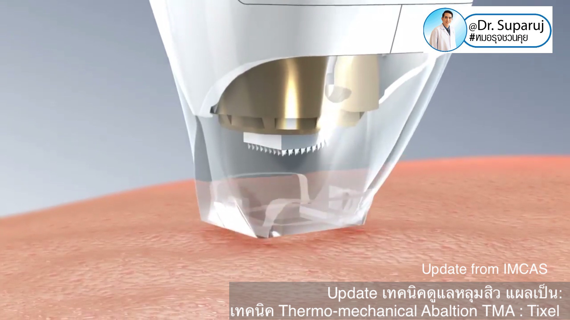 Update from IMCAS เทคนิครักษาหลุมสิว แผลเป็น ริ้วรอย: Tixel เทคนิค Thermo-mechanical Abaltion TMA Update from IMCAS เทคนิครักษาหลุมสิว แผลเป็น ริ้วรอย: Tixel เทคนิค Thermo-mechanical Abaltion TMA