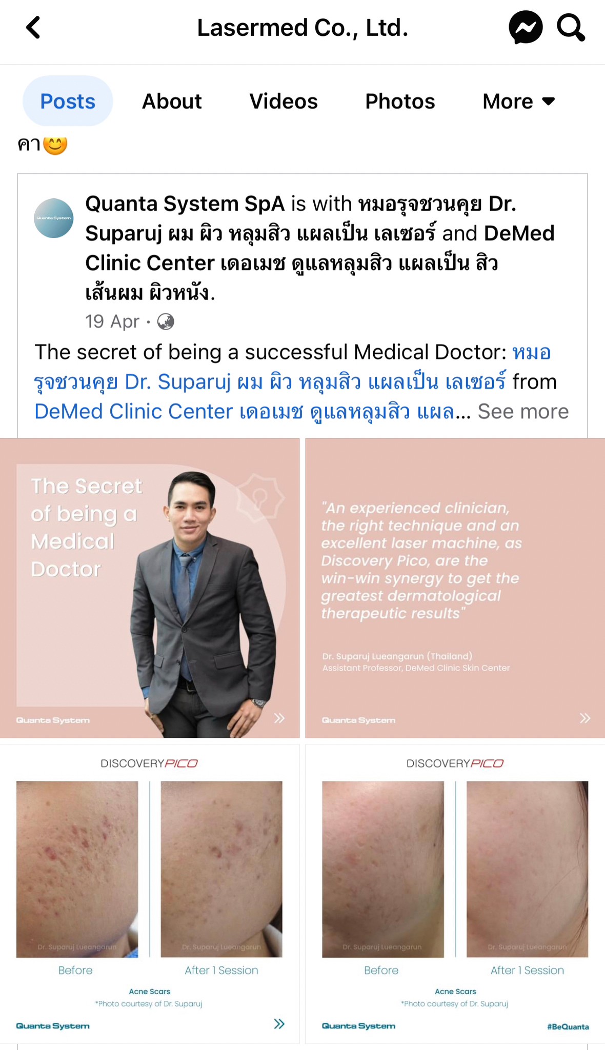 เทคนิคหลักการรักษาหลุมสิวด้วยเลเซอร์ Diacovery Pico Laser ของหมอรุจได้รับการเผยแพร่ในระดับนานาชาติของทางบริษัทระดับโลก Quanta System จากประเทศอิตาลีครับ เทคนิคหลักการรักษาหลุมสิวด้วยเลเซอร์ Diacovery Pico Laser ของหมอรุจได้รับการเผยแพร่ในระดับนานาชาติของทางบริษัทระดับโลก Quanta System จากประเทศอิตาลีครับ