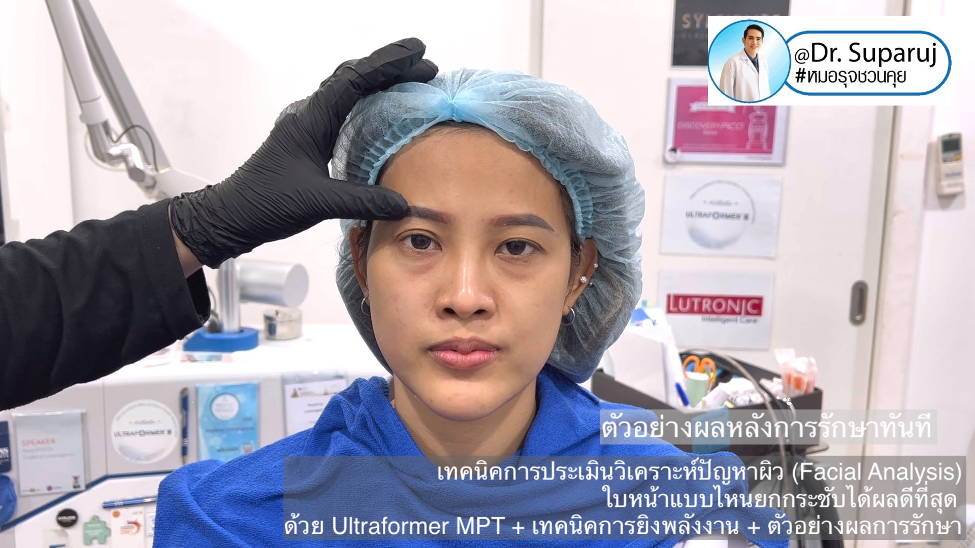 เทคนิคการประเมินวิเคราะห์ปัญหาผิว (Facial Analysis) ใบหน้าแบบไหนยกกระชับได้ผลดีที่สุด ด้วย Ultraformer MPT + เทคนิคการยิงพลังงาน + ตัวอย่างผลการรักษา