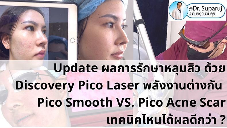  Update ผลการรักษาหลุมสิว ด้วย Discovery Pico Laser พลังงานต่างกัน Pico Smooth (Moderate Fluence) VS. Pico Acne Scar (High Fluence)เทคนิคไหนได้ผลดีกว่า ?