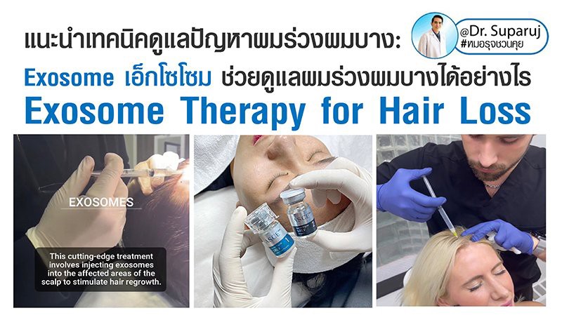 แนะนำเทคนิคดูแลปัญหาผมร่วงผมบาง: ASCE+™ HRLV Exosome เอเอสซีอีเอ็กโซโซม ช่วยดูแลผมร่วงผมบางได้อย่างไร? (ASCE+™ HRLV Exosome Therapy for Hair Loss) แนะนำเทคนิคดูแลปัญหาผมร่วงผมบาง: ASCE+™ HRLV Exosome เอเอสซีอีเอ็กโซโซม ช่วยดูแลผมร่วงผมบางได้อย่างไร? (ASCE+™ HRLV Exosome Therapy for Hair Loss)