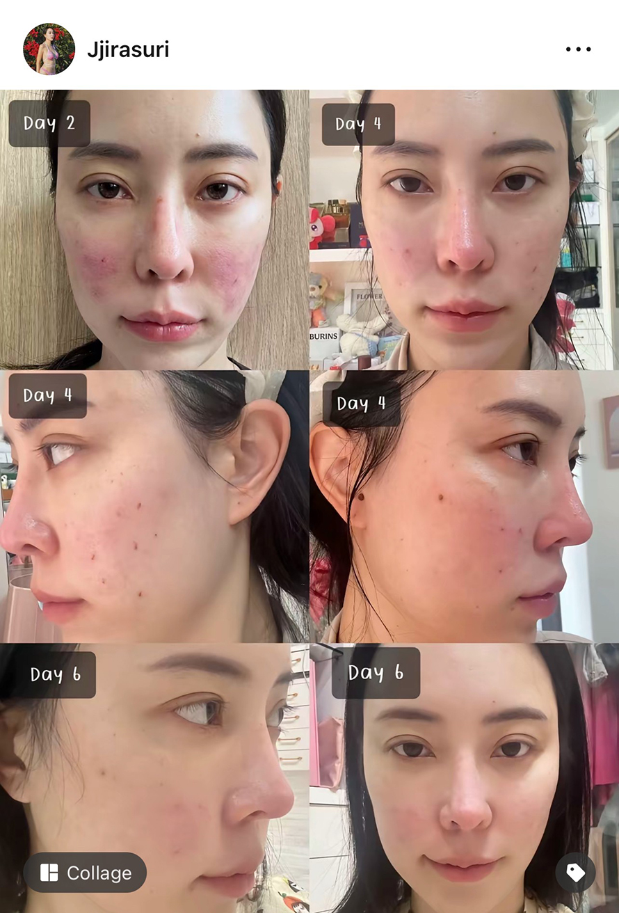 นอกใจโปรแกรมเลเซอร์ Pico ลองของใหม่ โปรแกรม SylfirmXplus ขอบคุณรีวิวดูแลหลุมสิวด้วยโปรแกรม SylfirmX Plus จากคุณจูนครับ นอกใจโปรแกรมเลเซอร์ Pico ลองของใหม่ โปรแกรม SylfirmXplus ขอบคุณรีวิวดูแลหลุมสิวด้วยโปรแกรม SylfirmX Plus จากคุณจูนครับ