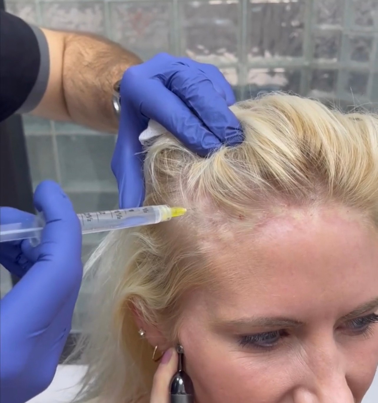 แนะนำเทคนิคดูแลปัญหาผมร่วงผมบาง: Exosome เอ็กโซโซม ช่วยดูแลผมร่วงผมบางได้อย่างไร? แนะนำเทคนิคดูแลปัญหาผมร่วงผมบาง: Exosome เอ็กโซโซม ช่วยดูแลผมร่วงผมบางได้อย่างไร?