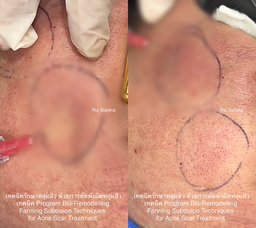 การรักษาหลุมสิวด้วยการตัดพังผืดควบคู่กับ Bio Remodelling HA Hybrid Complex เป็นทางเลือก