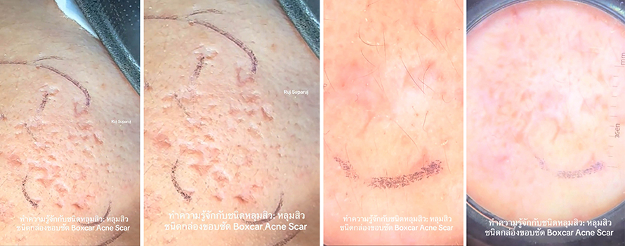 ทำความรู้จักชนิดหลุมสิว: Rolling, Boxcar และ Ice Pick Acne Scar ทำความรู้จักชนิดหลุมสิว: Rolling, Boxcar และ Ice Pick Acne Scar