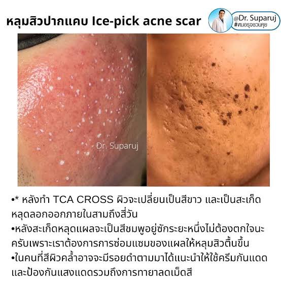 เป็นคนเจ็บง่าย (มากๆ) แต่อยากรักษาหลุมสิว มีเทคนิคอย่างไร? : เทคนิคลดอาการเจ็บจากการรักษาหลุมสิว เป็นคนเจ็บง่าย (มากๆ) แต่อยากรักษาหลุมสิว มีเทคนิคอย่างไร? : เทคนิคลดอาการเจ็บจากการรักษาหลุมสิว