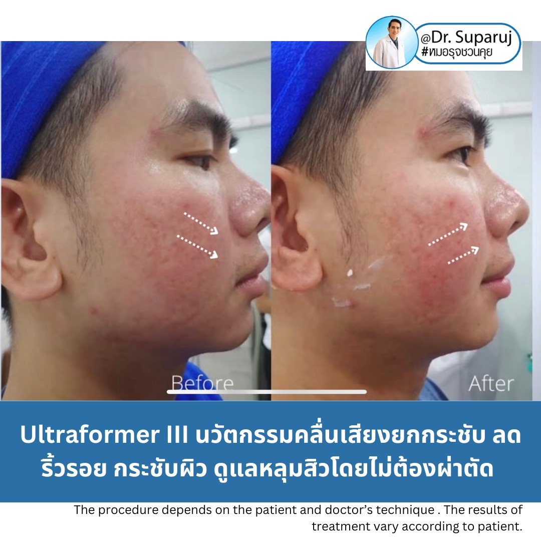 เทคโนโลยียกกระชับผิว MMFU : Micro &Macro Focused Ultrasound ของ Ultraformer III ทำงานอย่างไร ทำไมถึงดีกว่า HIFU ?