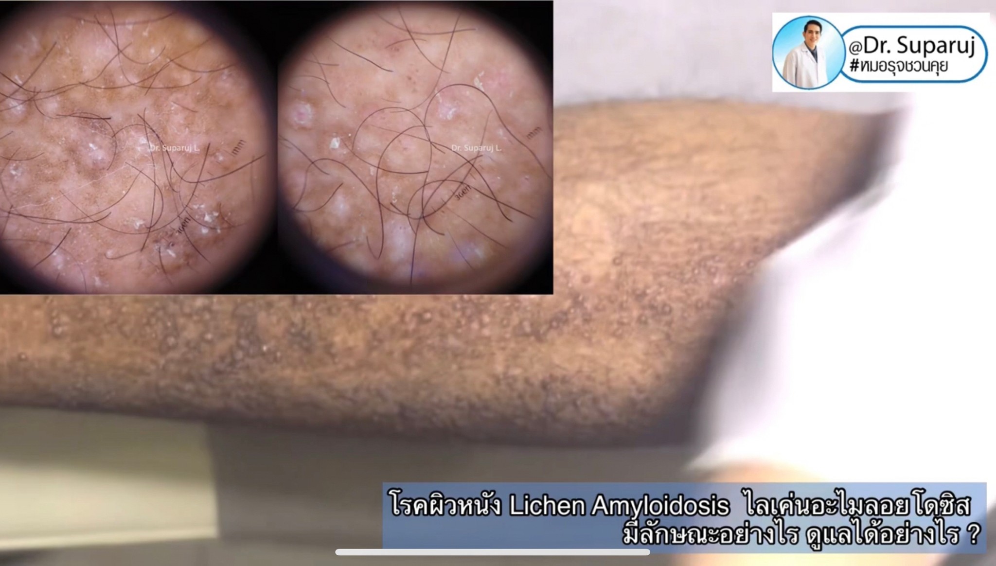 แนะนำการดูแลปัญหาโรคผิวหนัง: โรค Lichen amyloidosis ไลเค่น อะไมลอยโดซิส มีลักษณะอย่างไร ดูแลได้อย่างไร ? แนะนำการดูแลปัญหาโรคผิวหนัง: โรค Lichen amyloidosis ไลเค่น อะไมลอยโดซิส มีลักษณะอย่างไร ดูแลได้อย่างไร ?
