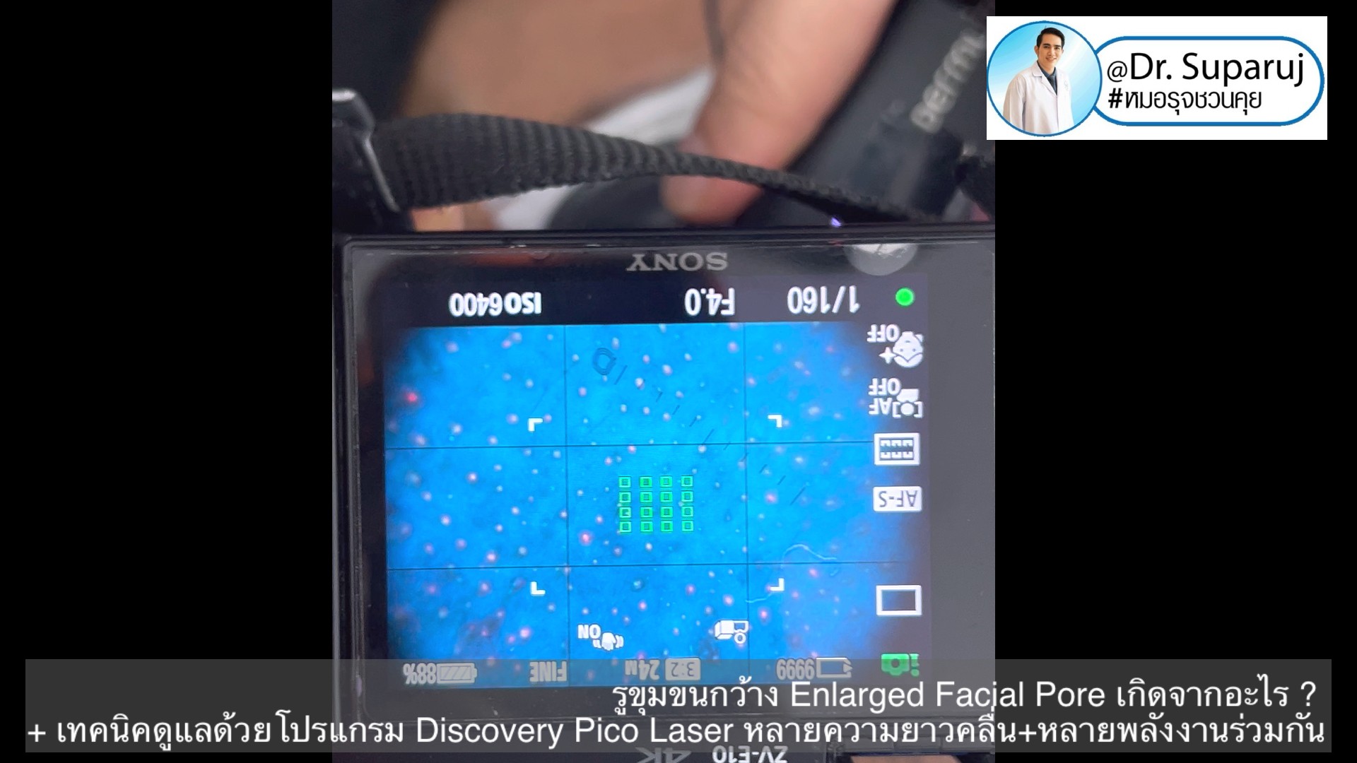 รูขุมขนกว้าง Enlarged Facial Pore เกิดจากอะไร ? + เทคนิคดูแลด้วยโปรแกรม Discovery Pico Laser หลายความยาวคลื่น +หลายพลังงานร่วมกัน รูขุมขนกว้าง Enlarged Facial Pore เกิดจากอะไร ? + เทคนิคดูแลด้วยโปรแกรม Discovery Pico Laser หลายความยาวคลื่น +หลายพลังงานร่วมกัน