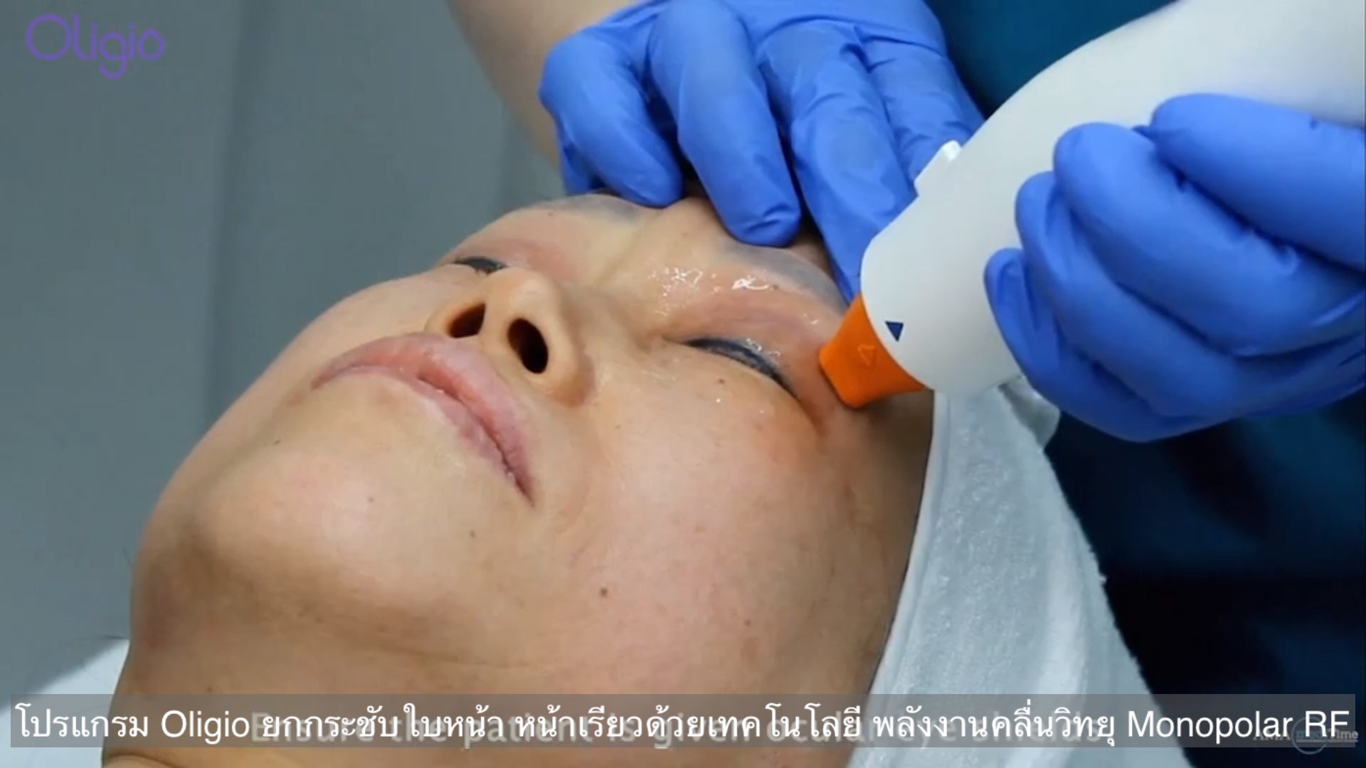 ยกกระชับผิวหน้าด้วย โปรแกรม Oligio Monopolar RF มีกลไก& จุดเด่น อย่างไร ? ยกกระชับผิวหน้าด้วย โปรแกรม Oligio Monopolar RF มีกลไก& จุดเด่น อย่างไร ?
