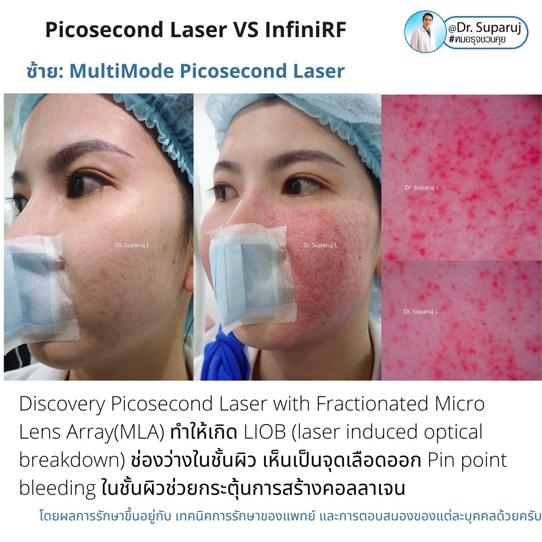 แนะนำเทคนิครักษาหลุมสิว: ดูแลหลุมสิวด้วยเข็มพลังงานคลื่นวิทยุ Infini RF Microneedle