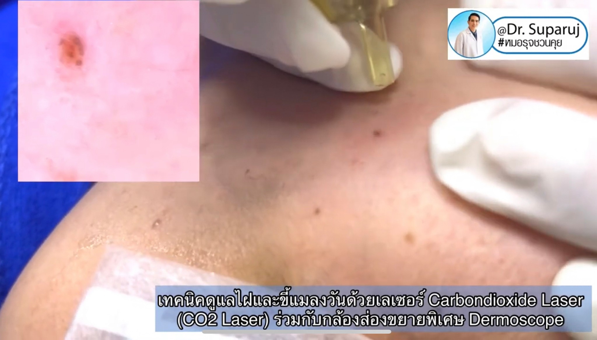 เทคนิคการใช้อุปกรณ์ช่วยวินิจฉัย & ดูแลปัญหาผิวหนัง ฝ้า กระ หลุมสิว: กล้องขยาย Dermoscopy, แว่นขยายพร้อมแสงในช่วงUV: Wood’s Lamp, เครื่องสแกนหาเส้นเลือด Vein Scanner เทคนิคการใช้อุปกรณ์ช่วยวินิจฉัย & ดูแลปัญหาผิวหนัง ฝ้า กระ หลุมสิว: กล้องขยาย Dermoscopy, แว่นขยายพร้อมแสงในช่วงUV: Wood’s Lamp, เครื่องสแกนหาเส้นเลือด Vein Scanner