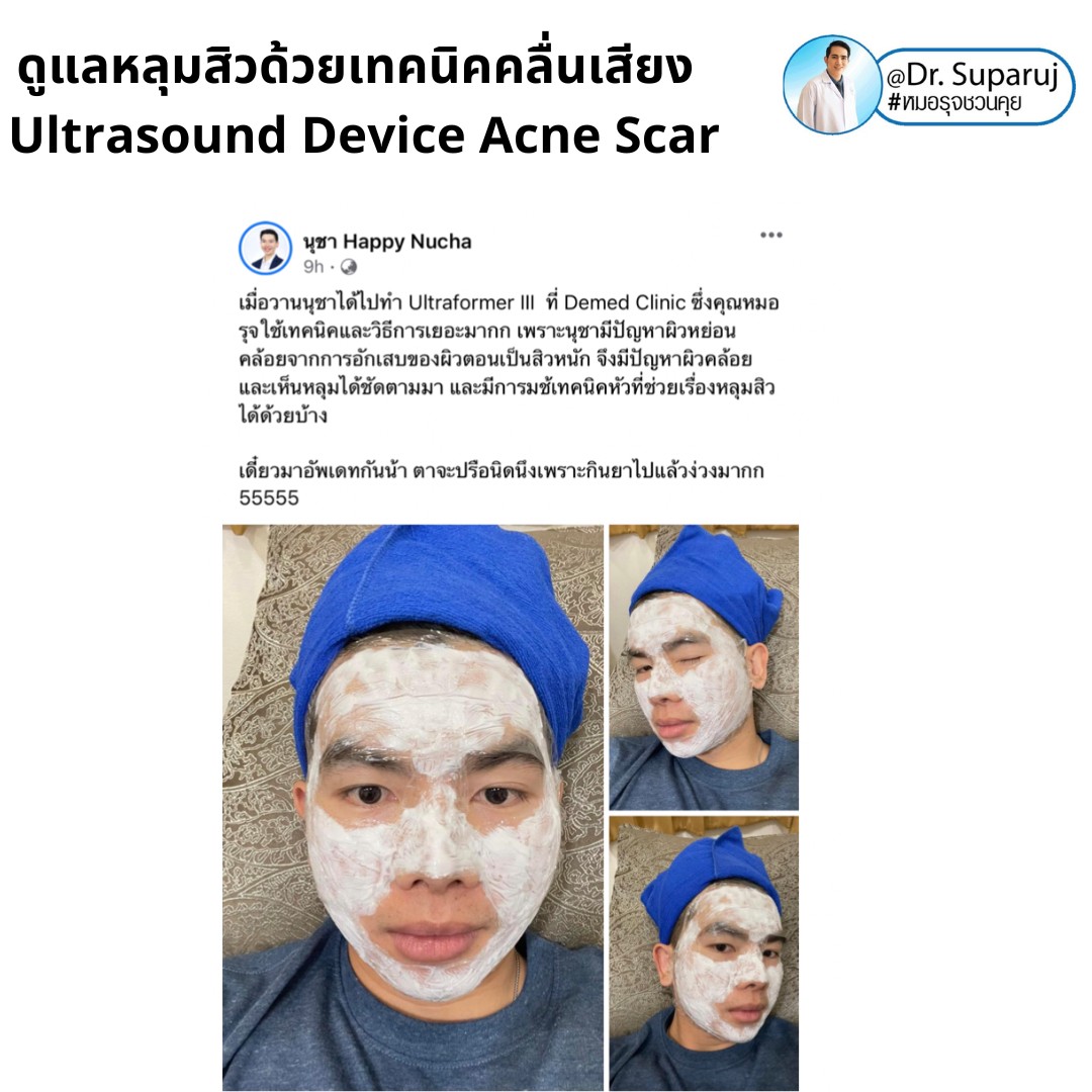 เทคโนโลยียกกระชับผิว MMFU : Micro &Macro Focused Ultrasound ของ Ultraformer III ทำงานอย่างไร ทำไมถึงดีกว่า HIFU ? เทคโนโลยียกกระชับผิว MMFU : Micro &Macro Focused Ultrasound ของ Ultraformer III ทำงานอย่างไร ทำไมถึงดีกว่า HIFU ?