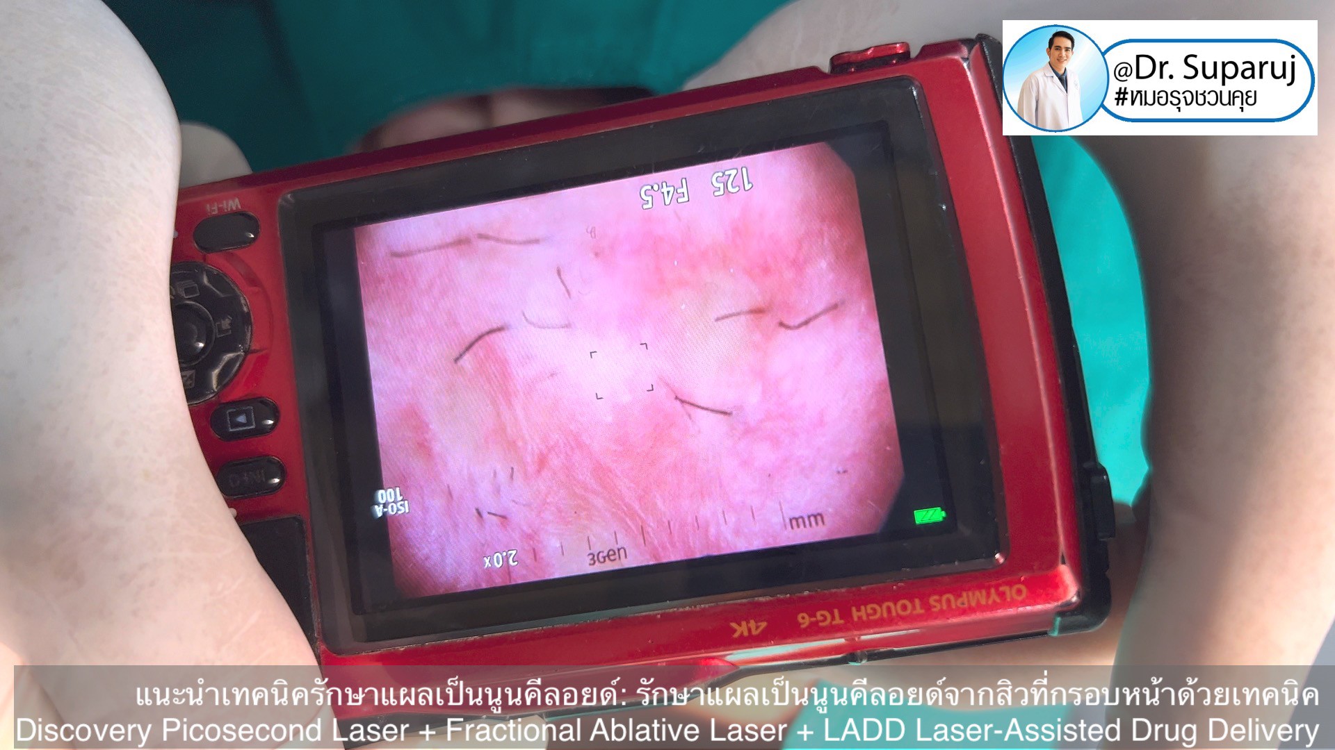 แนะนำเทคนิคดูแลแผลเป็นนูนคีลอยด์: รักษาแผลเป็นนูนคีลอยด์จากสิวที่กรอบหน้าด้วยเทคนิค Discovery Picosecond Laser + Fractional Ablative Laser + LADD Laser-Assisted Drug Delivery แนะนำเทคนิคดูแลแผลเป็นนูนคีลอยด์: รักษาแผลเป็นนูนคีลอยด์จากสิวที่กรอบหน้าด้วยเทคนิค Discovery Picosecond Laser + Fractional Ablative Laser + LADD Laser-Assisted Drug Delivery