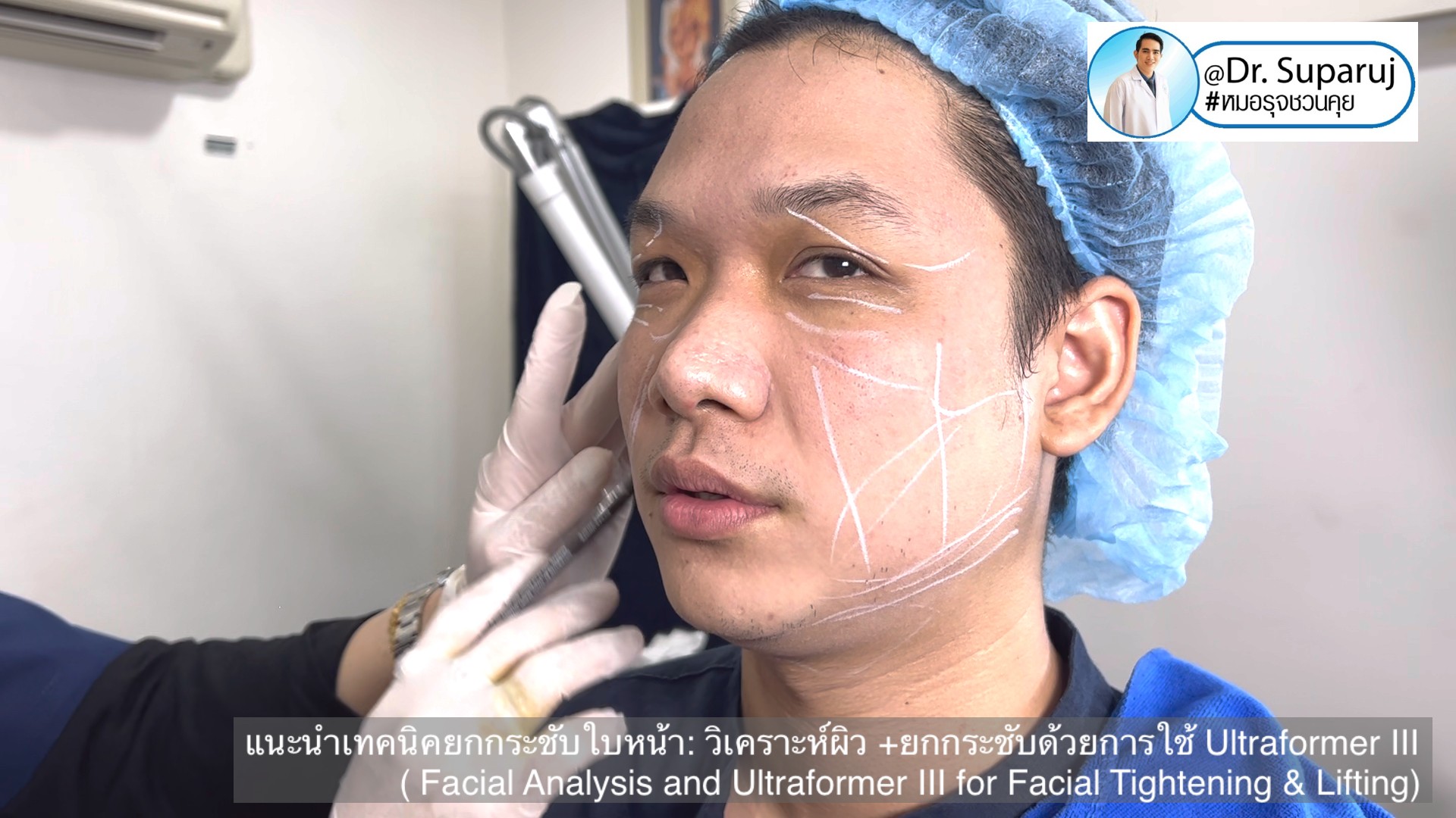 แนะนำเทคนิคยกกระชับใบหน้า: วิเคราะห์ผิว +ยกกระชับด้วย Ultraformer III ( Facial Analysis and Ultraformer III for Facial Tightening & Lifting)