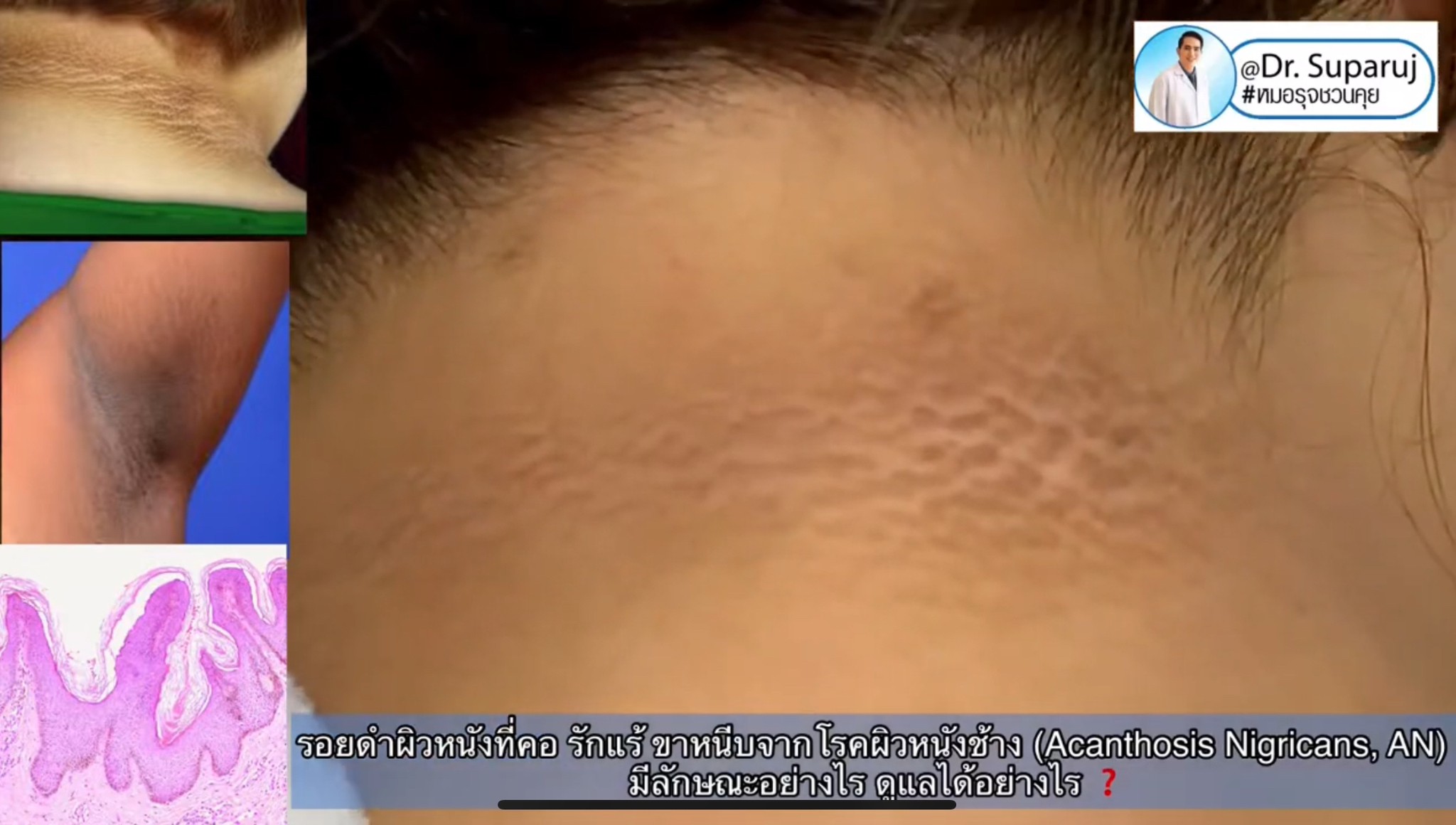 รักแร้ดำเกิดจากสาเหตุอะไร & ดูแลอย่างไร ? รักแร้ดำเกิดจากสาเหตุอะไร & ดูแลอย่างไร ?