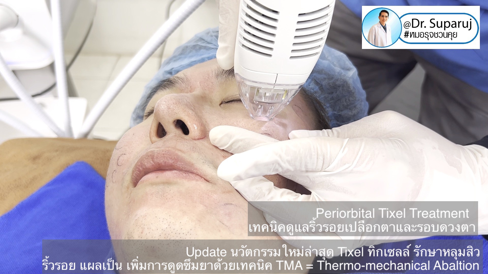 Update นวัตกรรมใหม่ล่าสุด Tixel ทิ๊กเซลล์ รักษาหลุมสิว ริ้วรอย แผลเป็น + Periorbital Tixel Treatment ดูแลริ้วรอยเปลือกตาและรอบดวงตาด้วยเทคนิค TMA = Thermo-mechanical Abaltion Update นวัตกรรมใหม่ล่าสุด Tixel ทิ๊กเซลล์ รักษาหลุมสิว ริ้วรอย แผลเป็น + Periorbital Tixel Treatment ดูแลริ้วรอยเปลือกตาและรอบดวงตาด้วยเทคนิค TMA = Thermo-mechanical Abaltion