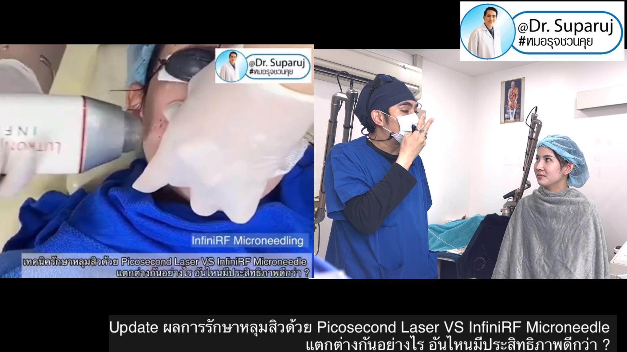 แนะนำเทคนิครักษาหลุมสิว: ดูแลหลุมสิวด้วยเข็มพลังงานคลื่นวิทยุ Infini RF Microneedle