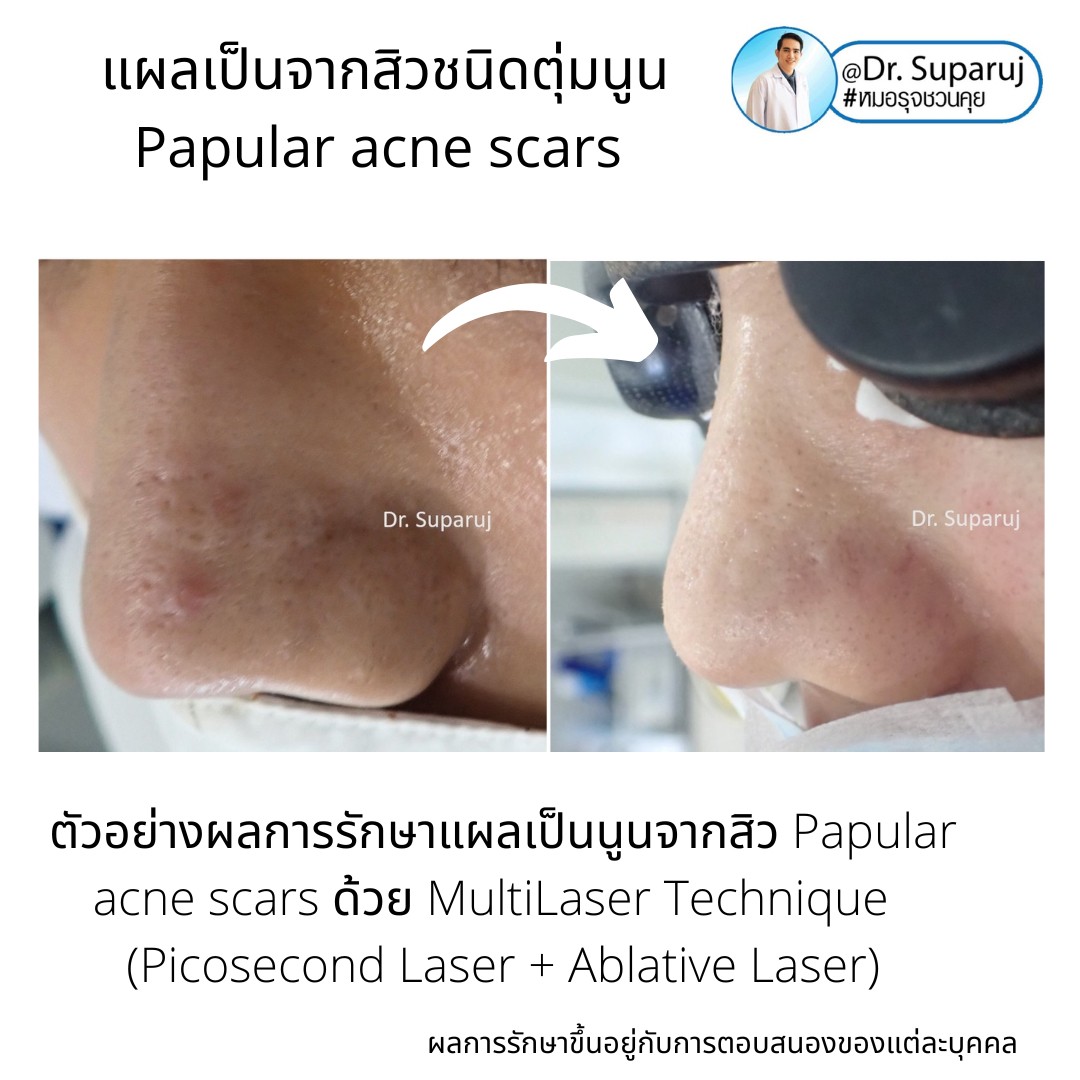 เทคนิคดูแลแผลเป็นตุ่มนูนจากสิว Papular acne scar ที่จมูก + คาง ด้วย Fractional Discovery Picosecond Laser + Deep Focused Ablative Laser เทคนิคดูแลแผลเป็นตุ่มนูนจากสิว Papular acne scar ที่จมูก + คาง ด้วย Fractional Discovery Picosecond Laser + Deep Focused Ablative Laser