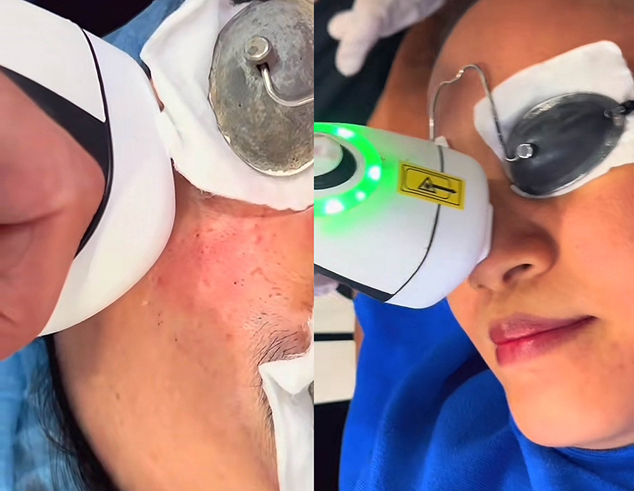 หลุมสิวที่มีรอยแดง Post Acne Redness and Acne Scar เกิดจากอะไร & ดูแลได้อย่างไร ? หลุมสิวที่มีรอยแดง Post Acne Redness and Acne Scar เกิดจากอะไร & ดูแลได้อย่างไร ?