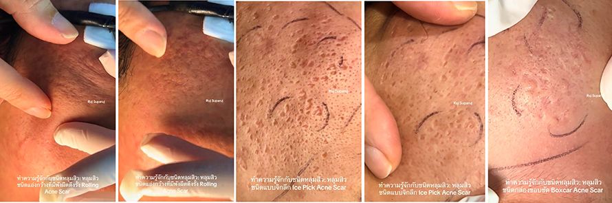 ทำความรู้จักชนิดหลุมสิว: Rolling, Boxcar และ Ice Pick Acne Scar