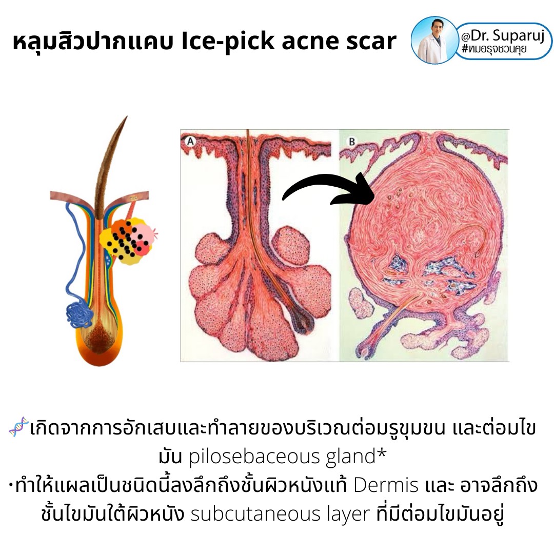 แนะนำเทคนิครักษาหลุมสิวจิกลึก Ice Pick Acne Scar ด้วยเทคนิคเลเซอร์ UltraDeep Pico Technique (Ice Pick Acne Scar Treatment with Discovery Pico Laser + UltraDeep Pico Technique) แนะนำเทคนิครักษาหลุมสิวจิกลึก Ice Pick Acne Scar ด้วยเทคนิคเลเซอร์ UltraDeep Pico Technique (Ice Pick Acne Scar Treatment with Discovery Pico Laser + UltraDeep Pico Technique)