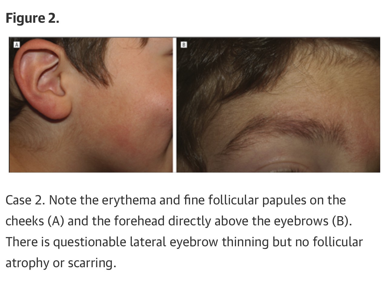 ขนคุดที่มีสีแดง KP Rubra มีลักษณะอย่างไร & ดูแลได้อย่างไร? ขนคุดที่มีสีแดง KP Rubra มีลักษณะอย่างไร & ดูแลได้อย่างไร?