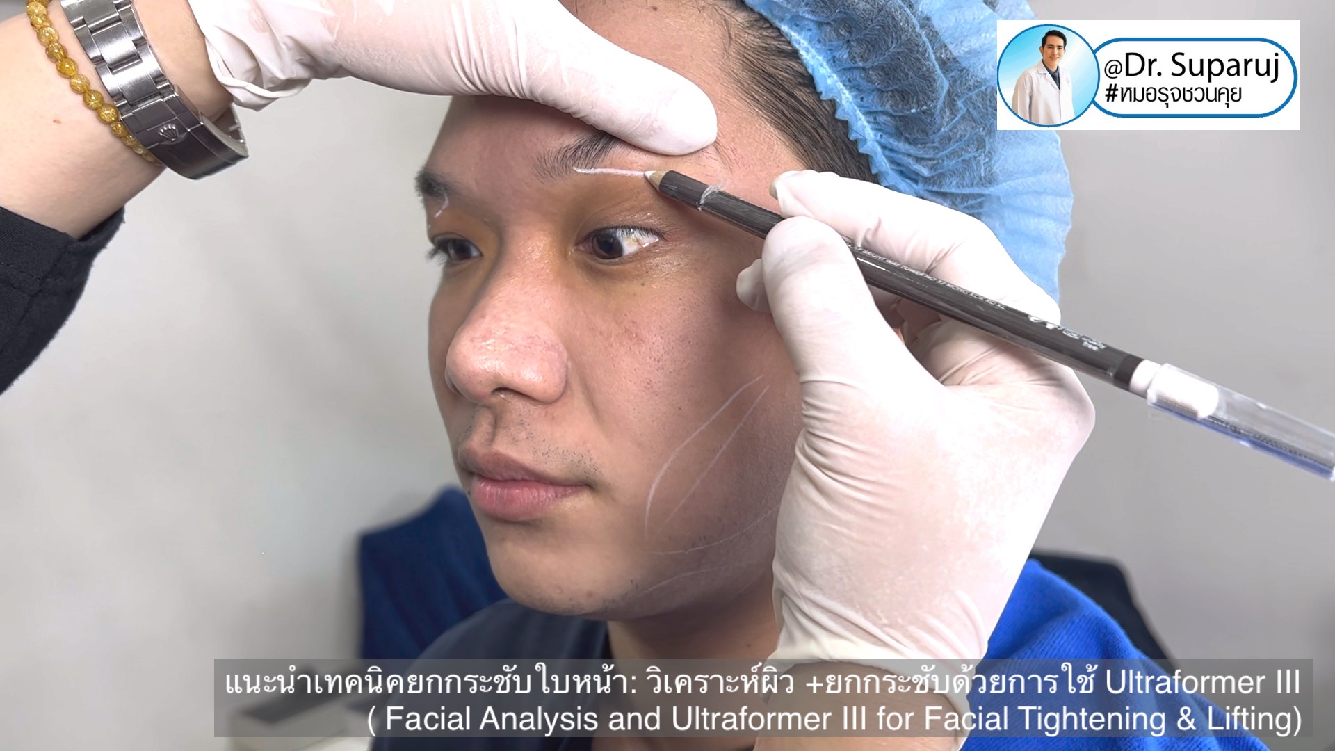 แนะนำเทคนิคยกกระชับใบหน้า: วิเคราะห์ผิว +ยกกระชับด้วย Ultraformer III ( Facial Analysis and Ultraformer III for Facial Tightening & Lifting) แนะนำเทคนิคยกกระชับใบหน้า: วิเคราะห์ผิว +ยกกระชับด้วย Ultraformer III ( Facial Analysis and Ultraformer III for Facial Tightening & Lifting)