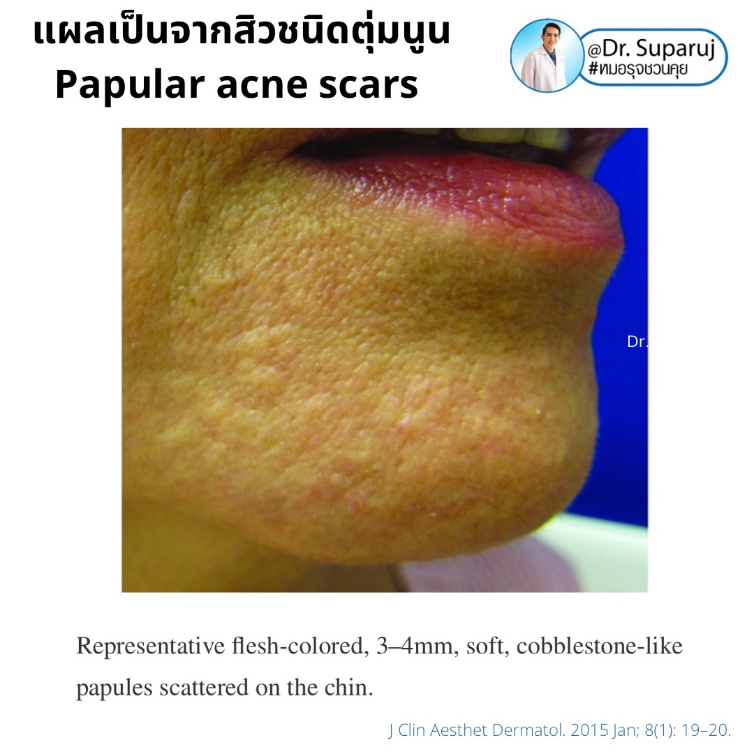 เทคนิคดูแลแผลเป็นตุ่มนูนจากสิว Papular acne scar ที่จมูก + คาง ด้วย Fractional Discovery Picosecond Laser + Deep Focused Ablative Laser เทคนิคดูแลแผลเป็นตุ่มนูนจากสิว Papular acne scar ที่จมูก + คาง ด้วย Fractional Discovery Picosecond Laser + Deep Focused Ablative Laser