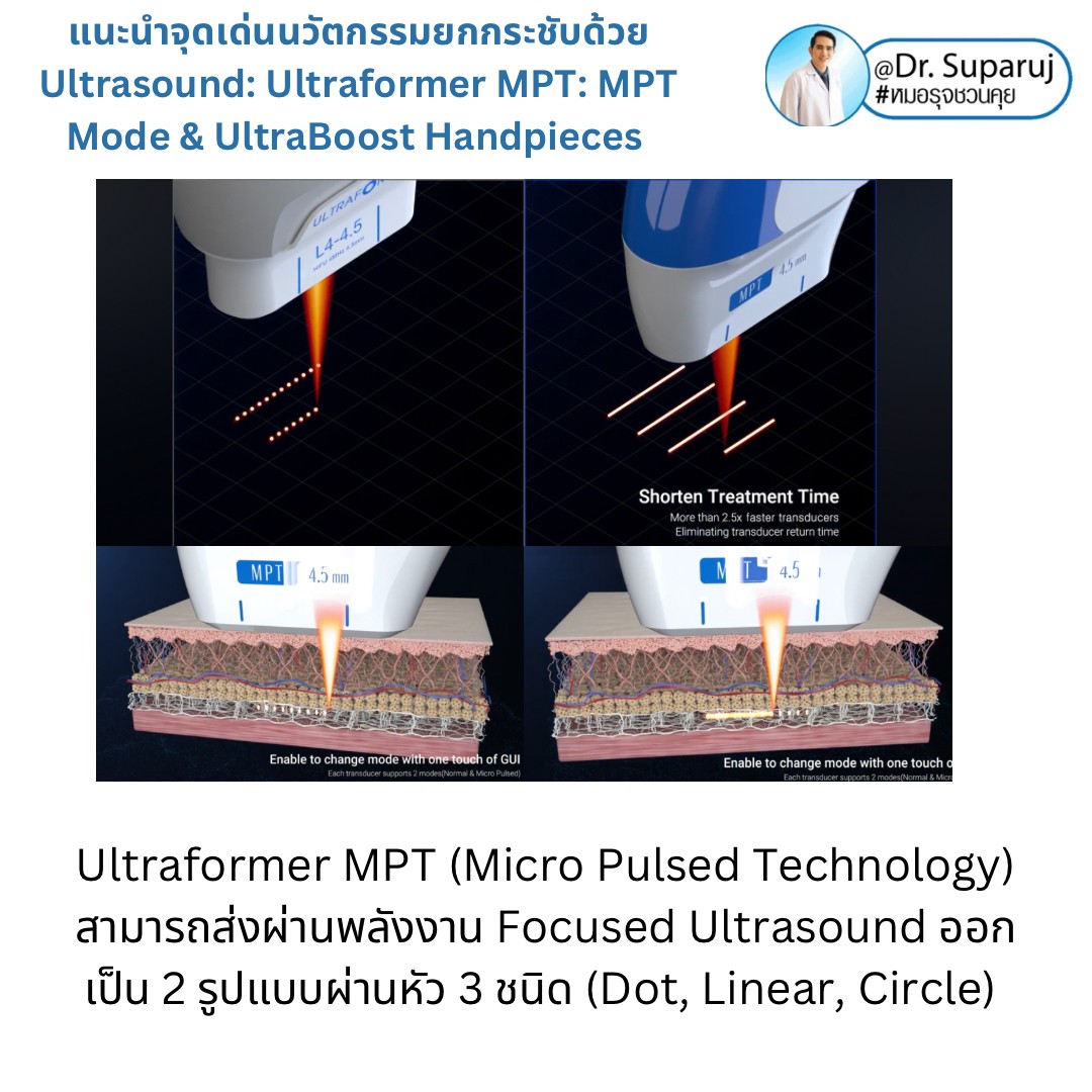 แนะนำนวัตกรรม พลังงานเครื่องเสียง Macro & Micro Focused Ultrasound ยกกระชับผิว Ultraformer MPT: จุดเด่น + ทดสอบลักษณะพลังงาน + การประเมินลักษณะผิว ให้เห็นกันชัดๆเลยครับ แนะนำนวัตกรรม พลังงานเครื่องเสียง Macro & Micro Focused Ultrasound ยกกระชับผิว Ultraformer MPT: จุดเด่น + ทดสอบลักษณะพลังงาน + การประเมินลักษณะผิว ให้เห็นกันชัดๆเลยครับ