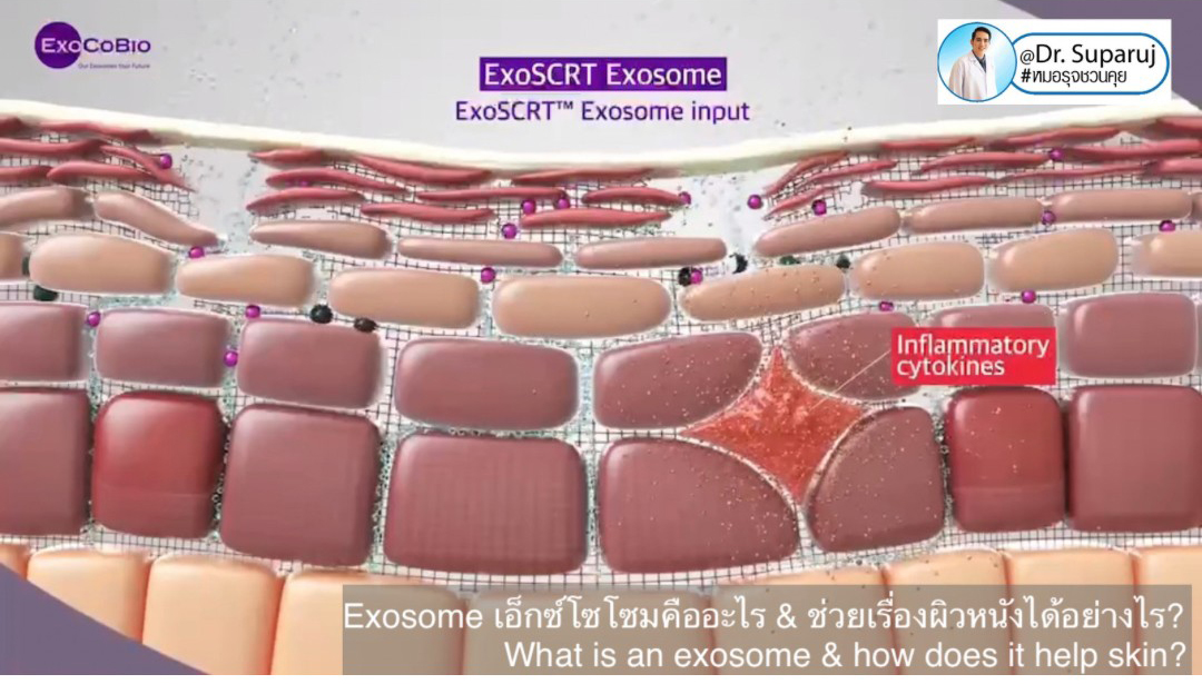 Exosomes มีบทบาทและกลไกในการดูแลฝ้า หรือไม่ & กลไกลเป็นอย่างไร ? Exosomes มีบทบาทและกลไกในการดูแลฝ้า หรือไม่ & กลไกลเป็นอย่างไร ?