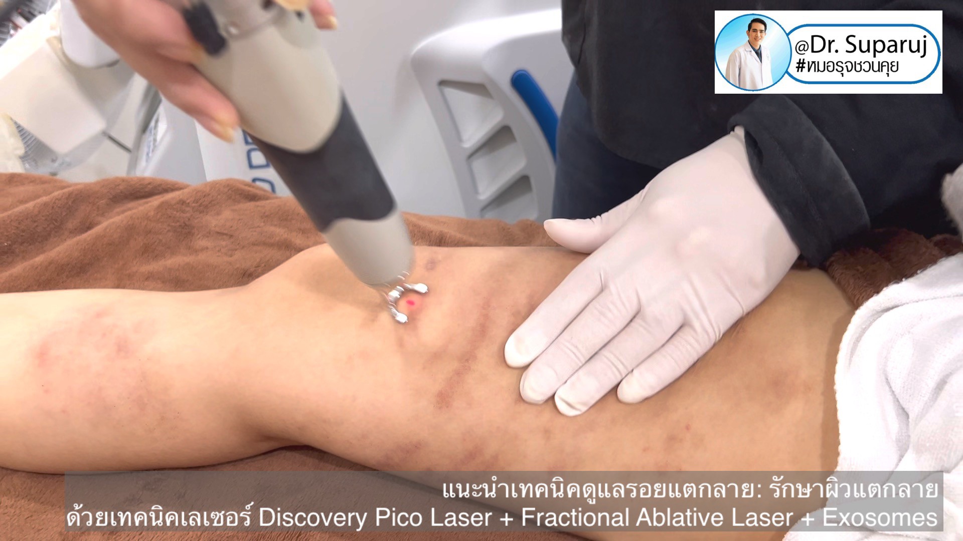 แนะนำเทคนิคดูแลรอยแตกลาย: รักษาผิวแตกลายด้วยเทคนิคเลเซอร์ Discovery Pico Laser + Fractional Ablative Laser + Exosomes แนะนำเทคนิคดูแลรอยแตกลาย: รักษาผิวแตกลายด้วยเทคนิคเลเซอร์ Discovery Pico Laser + Fractional Ablative Laser + Exosomes