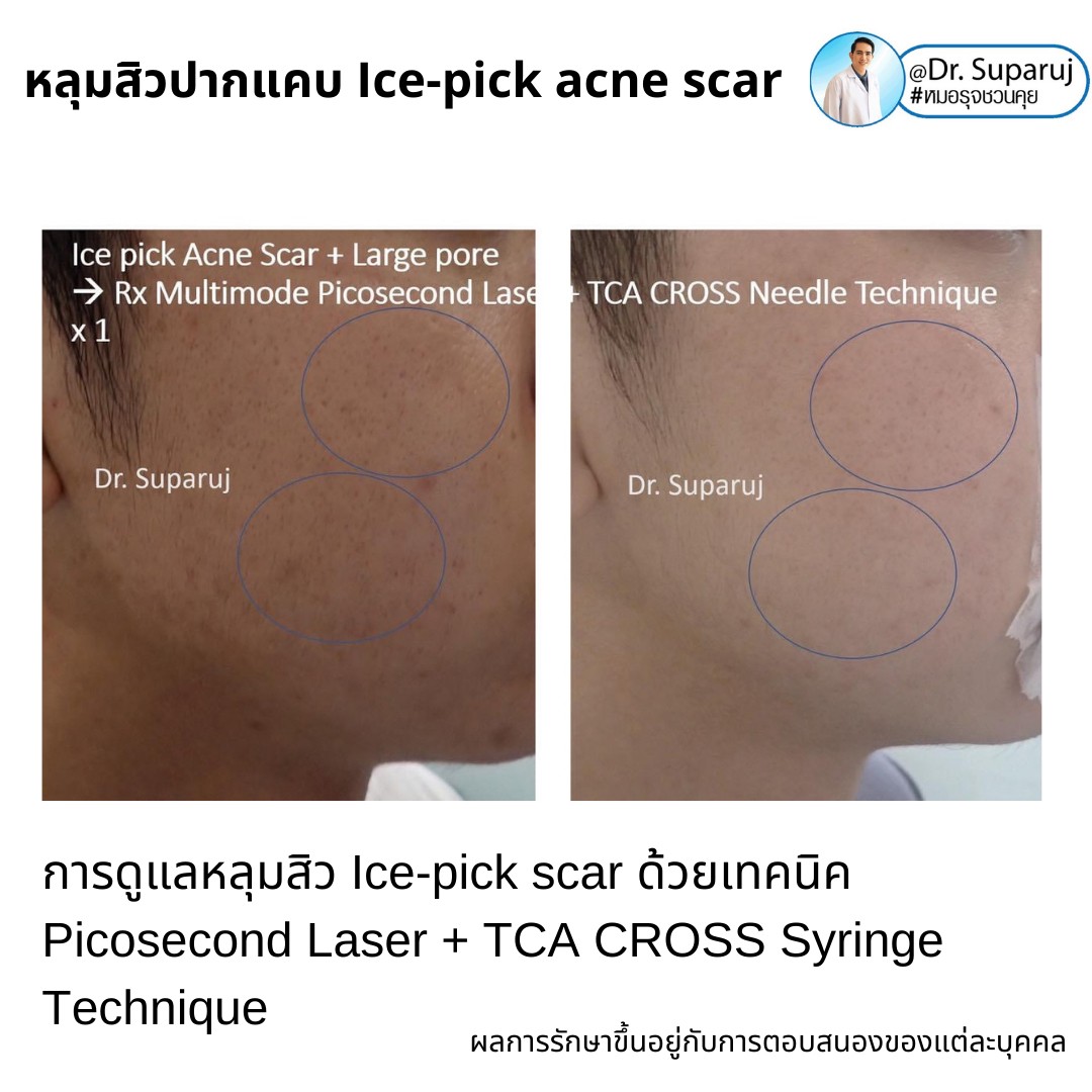  แนะนำเทคนิครักษาหลุมสิวจิกลึก Ice Pick Acne Scar ด้วยเทคนิคเลเซอร์ UltraDeep Pico Technique (Ice Pick Acne Scar Treatment with Discovery Pico Laser + UltraDeep Pico Technique)