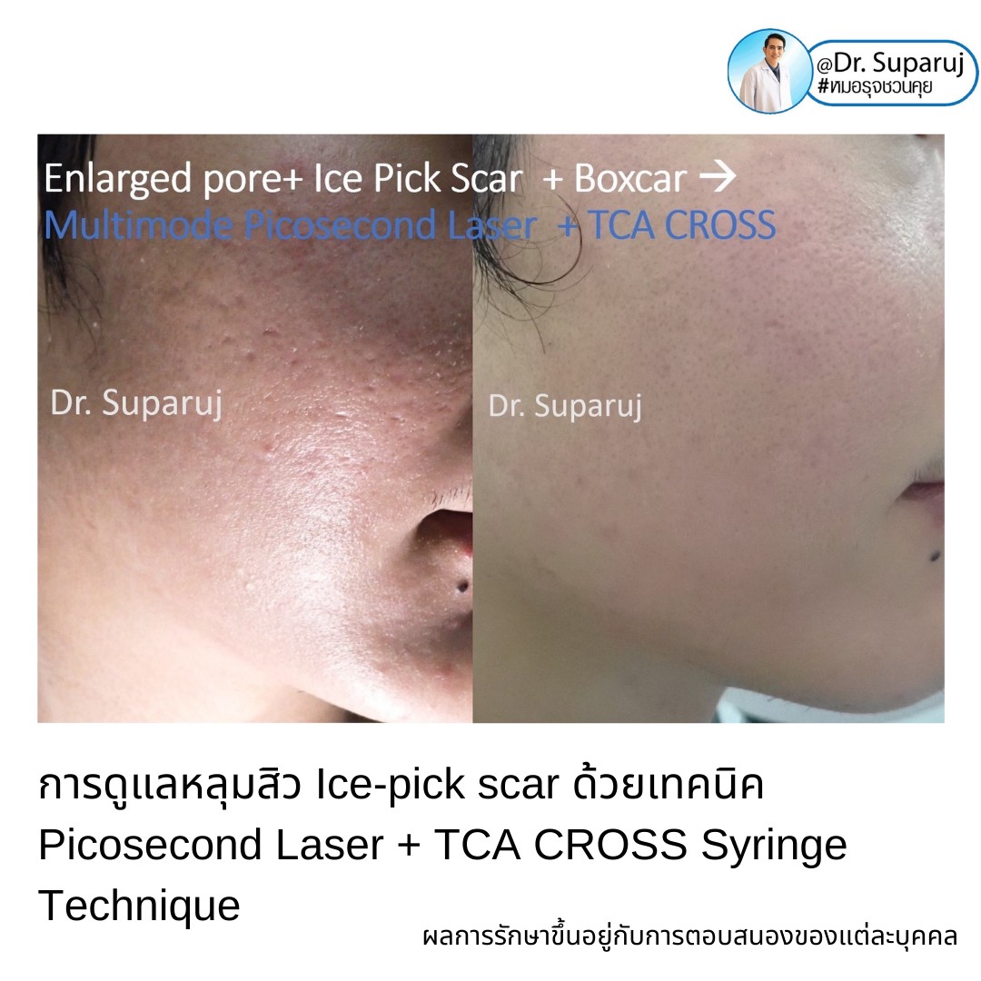 แนะนำเทคนิครักษาหลุมสิวจิกลึก Ice Pick Acne Scar ด้วยเทคนิคเลเซอร์ UltraDeep Pico Technique (Ice Pick Acne Scar Treatment with Discovery Pico Laser + UltraDeep Pico Technique) แนะนำเทคนิครักษาหลุมสิวจิกลึก Ice Pick Acne Scar ด้วยเทคนิคเลเซอร์ UltraDeep Pico Technique (Ice Pick Acne Scar Treatment with Discovery Pico Laser + UltraDeep Pico Technique)