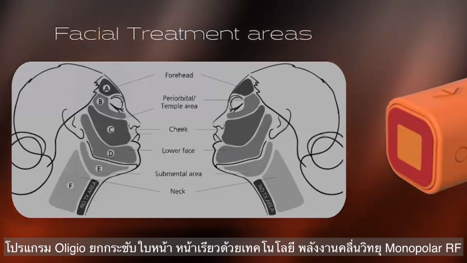 ยกกระชับผิวหน้าด้วย โปรแกรม Oligio Monopolar RF มีกลไก& จุดเด่น อย่างไร ? ยกกระชับผิวหน้าด้วย โปรแกรม Oligio Monopolar RF มีกลไก& จุดเด่น อย่างไร ?