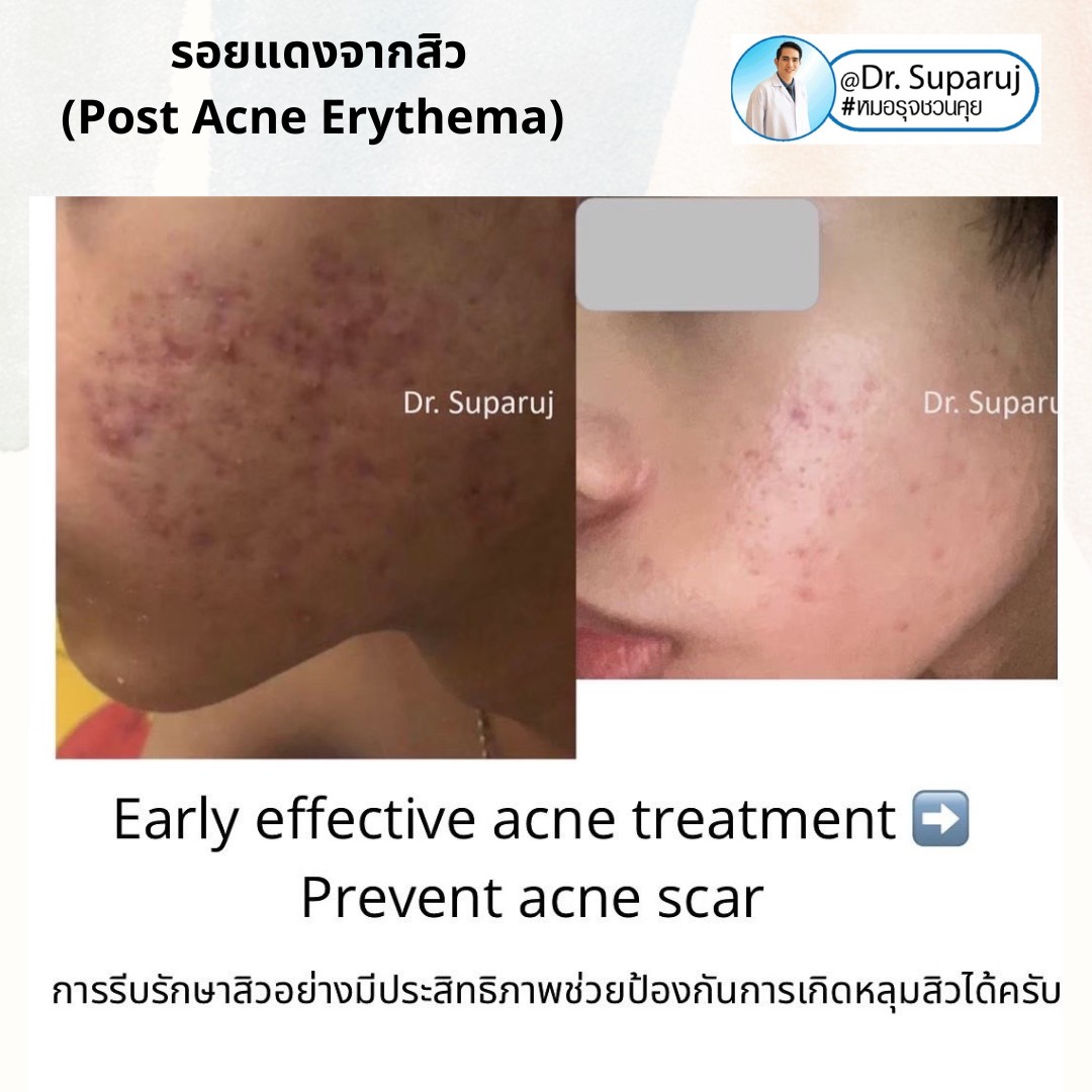 แนะนำเทคนิคดูแลรอยแดงสิว เส้นเลือดฝอย : เทคนิครักษารอยแดงสิว เส้นเลือดฝอย ด้วย Discovery Picosecond Laser PT Microsecond Pulses Mode แนะนำเทคนิคดูแลรอยแดงสิว เส้นเลือดฝอย : เทคนิครักษารอยแดงสิว เส้นเลือดฝอย ด้วย Discovery Picosecond Laser PT Microsecond Pulses Mode