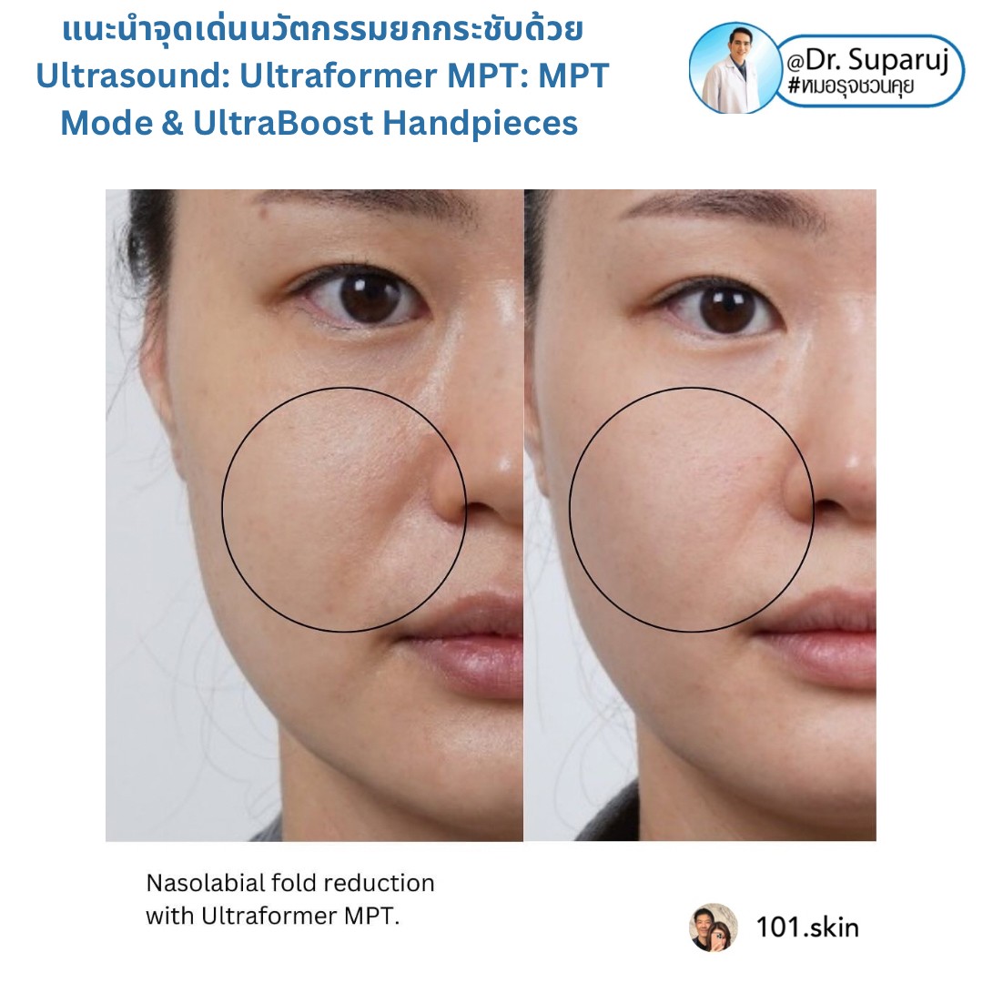 แนะนำนวัตกรรม พลังงานเครื่องเสียง Macro & Micro Focused Ultrasound ยกกระชับผิว Ultraformer MPT: จุดเด่น + ทดสอบลักษณะพลังงาน + การประเมินลักษณะผิว ให้เห็นกันชัดๆเลยครับ แนะนำนวัตกรรม พลังงานเครื่องเสียง Macro & Micro Focused Ultrasound ยกกระชับผิว Ultraformer MPT: จุดเด่น + ทดสอบลักษณะพลังงาน + การประเมินลักษณะผิว ให้เห็นกันชัดๆเลยครับ